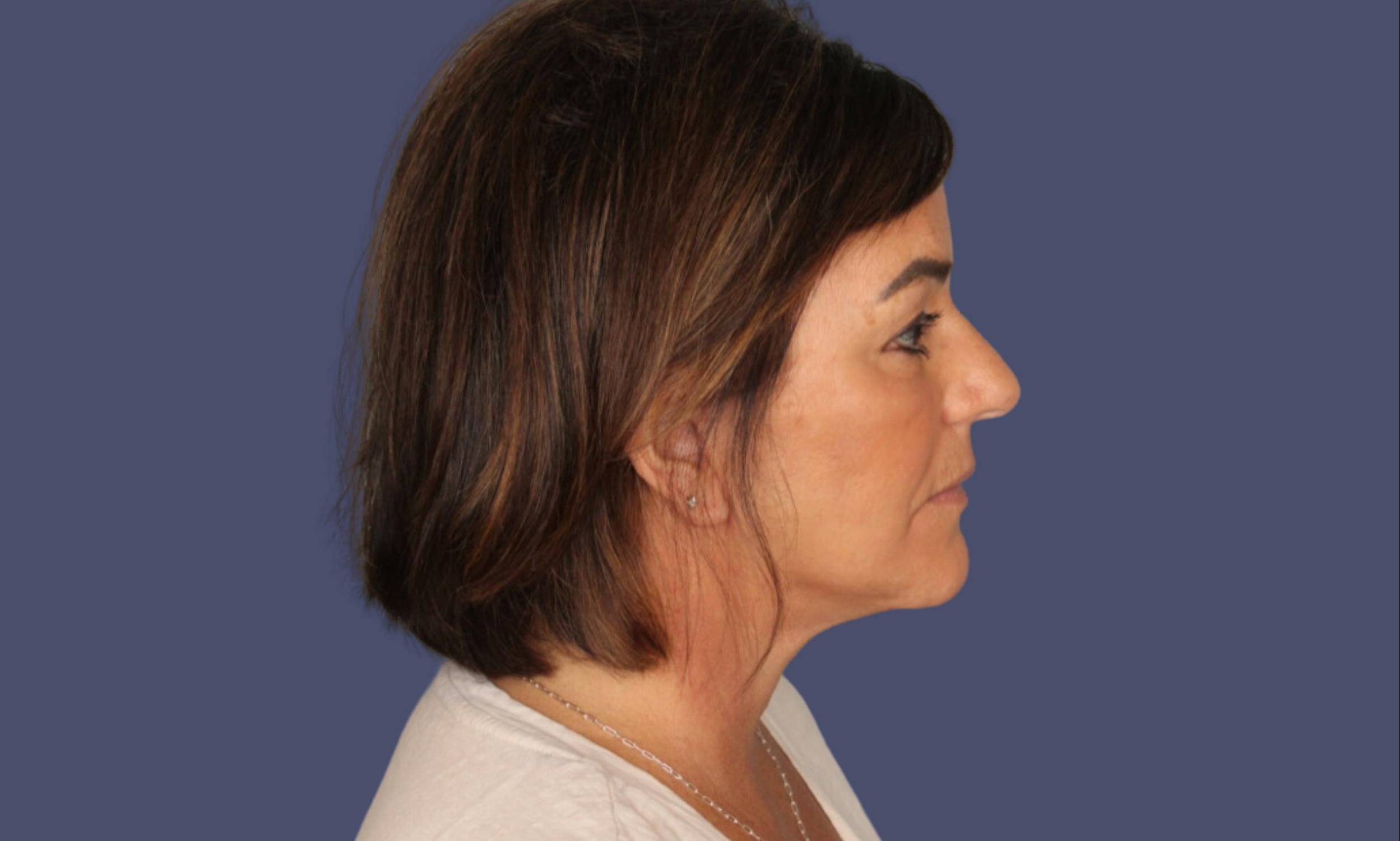 1 - Facelift & Necklift After