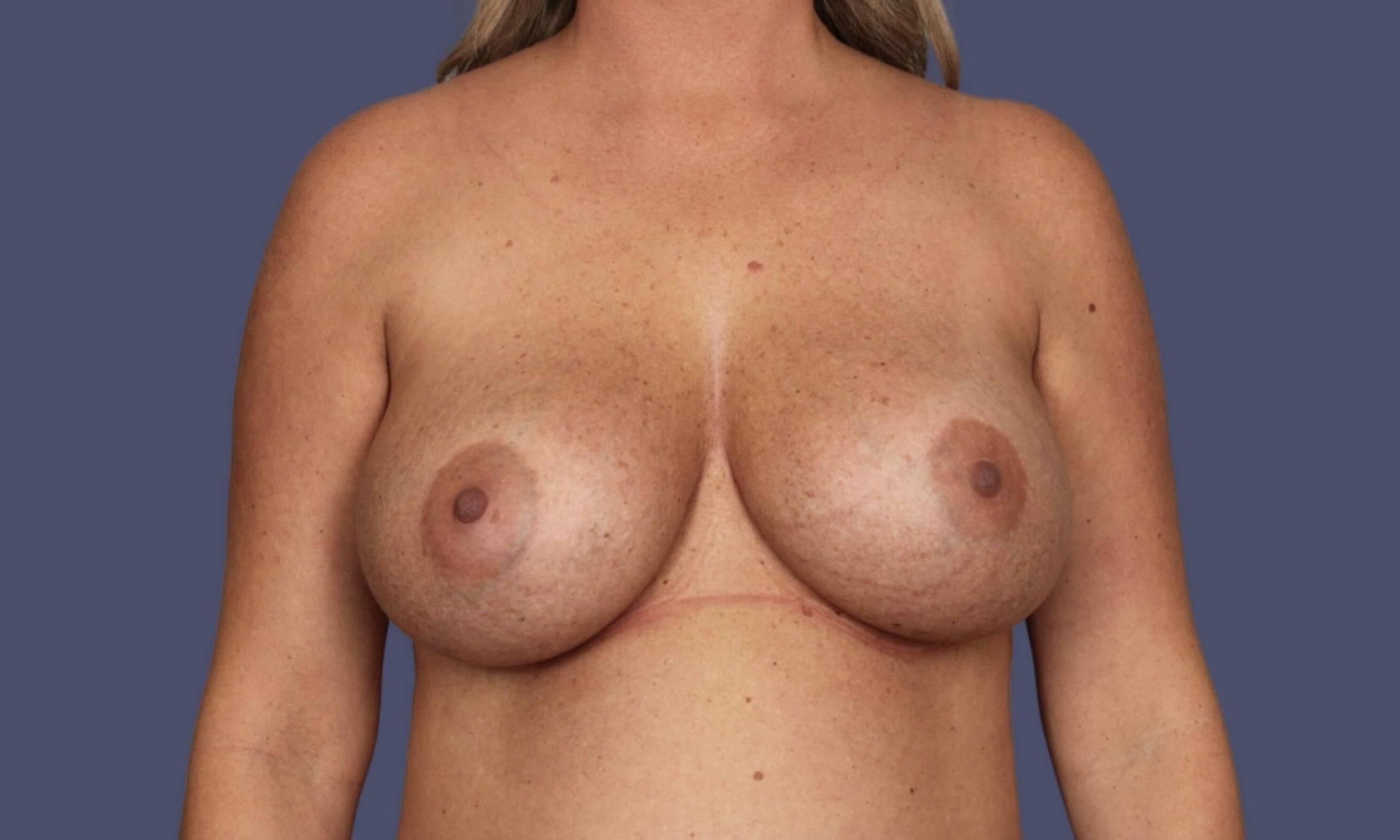 Breast Revision 6 Before