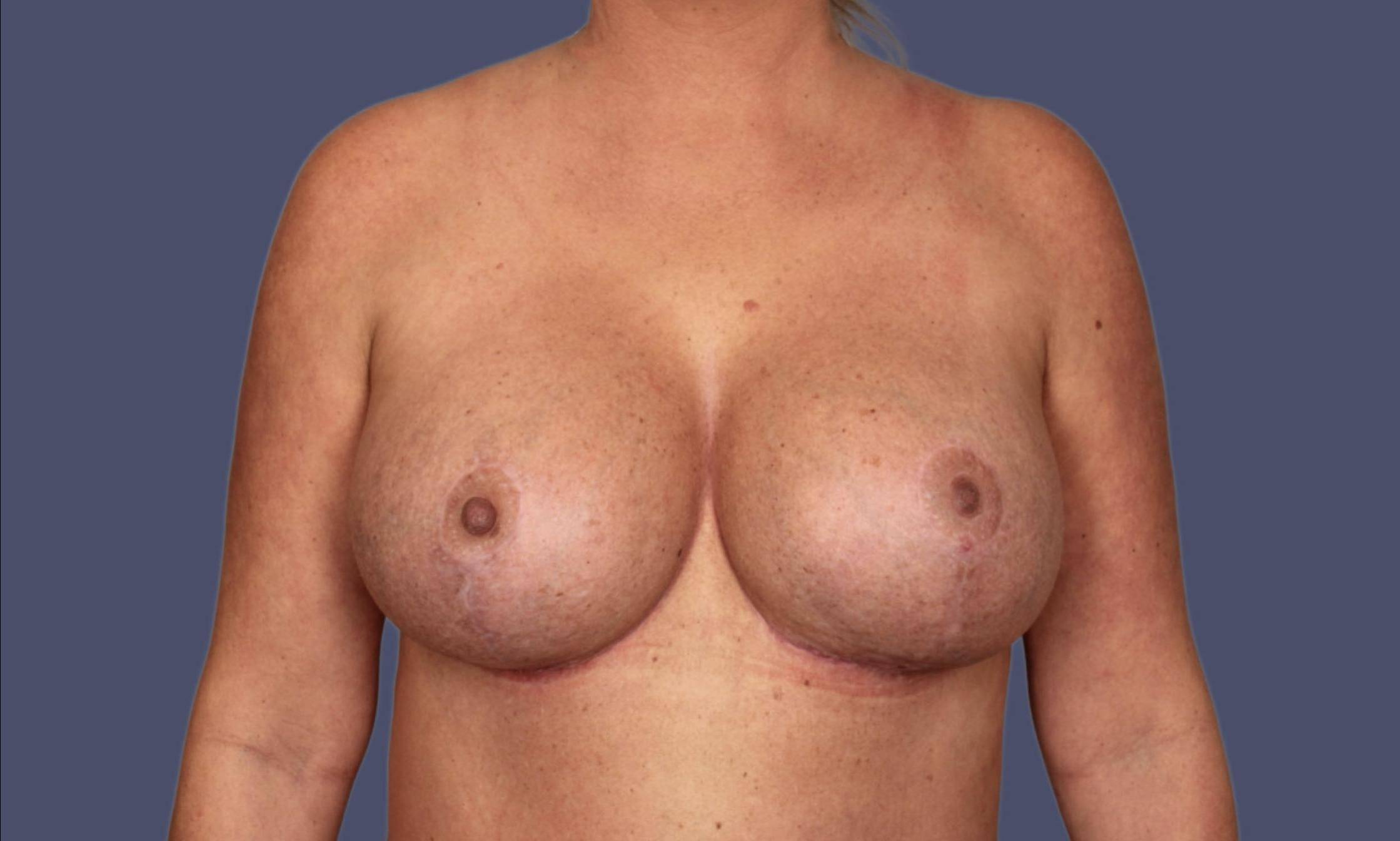 Breast Revision 6 After