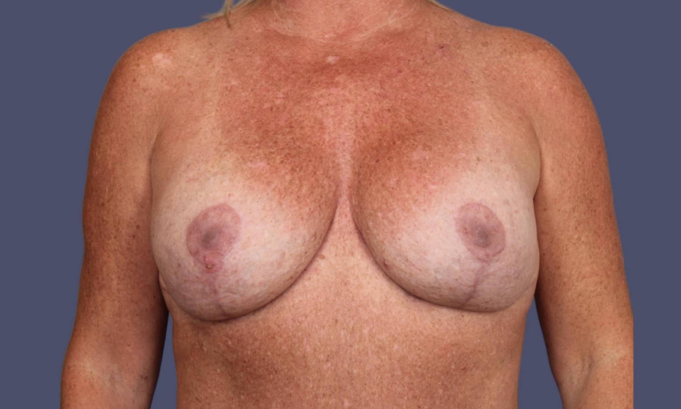 Breast Revision 7 After