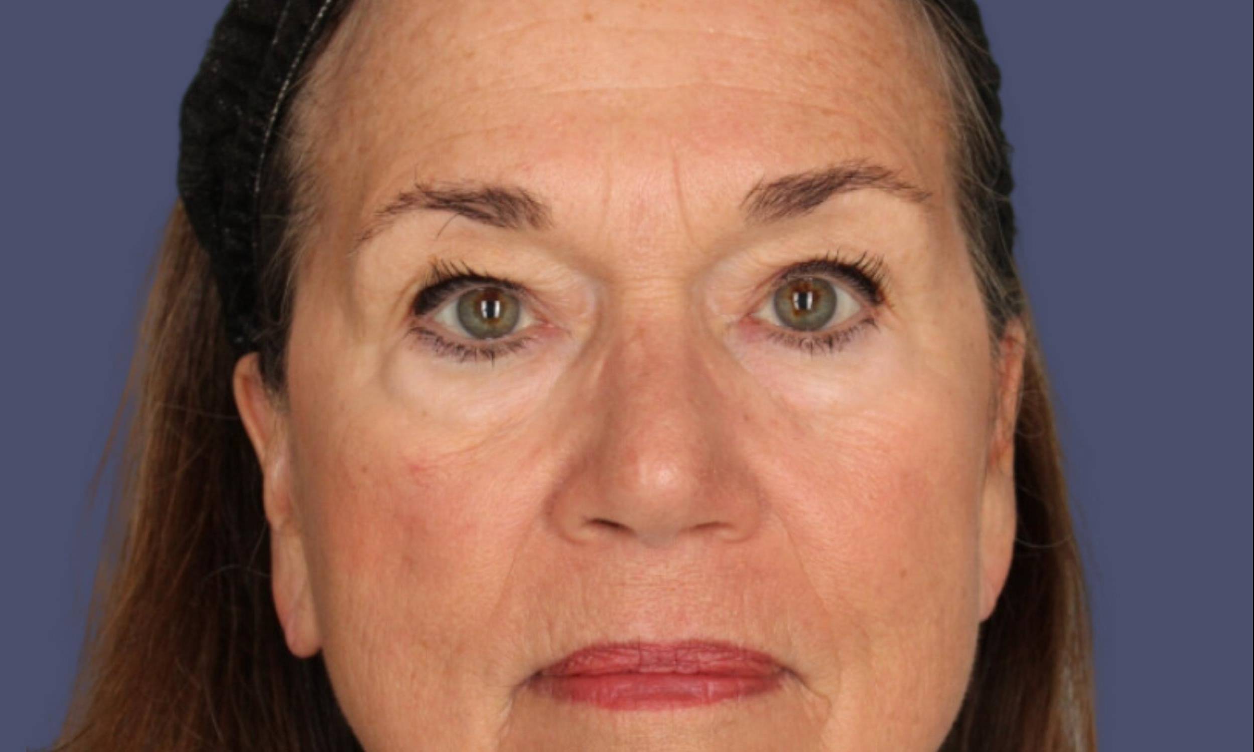 Blepharoplasty 15 - Upper & Lower Before