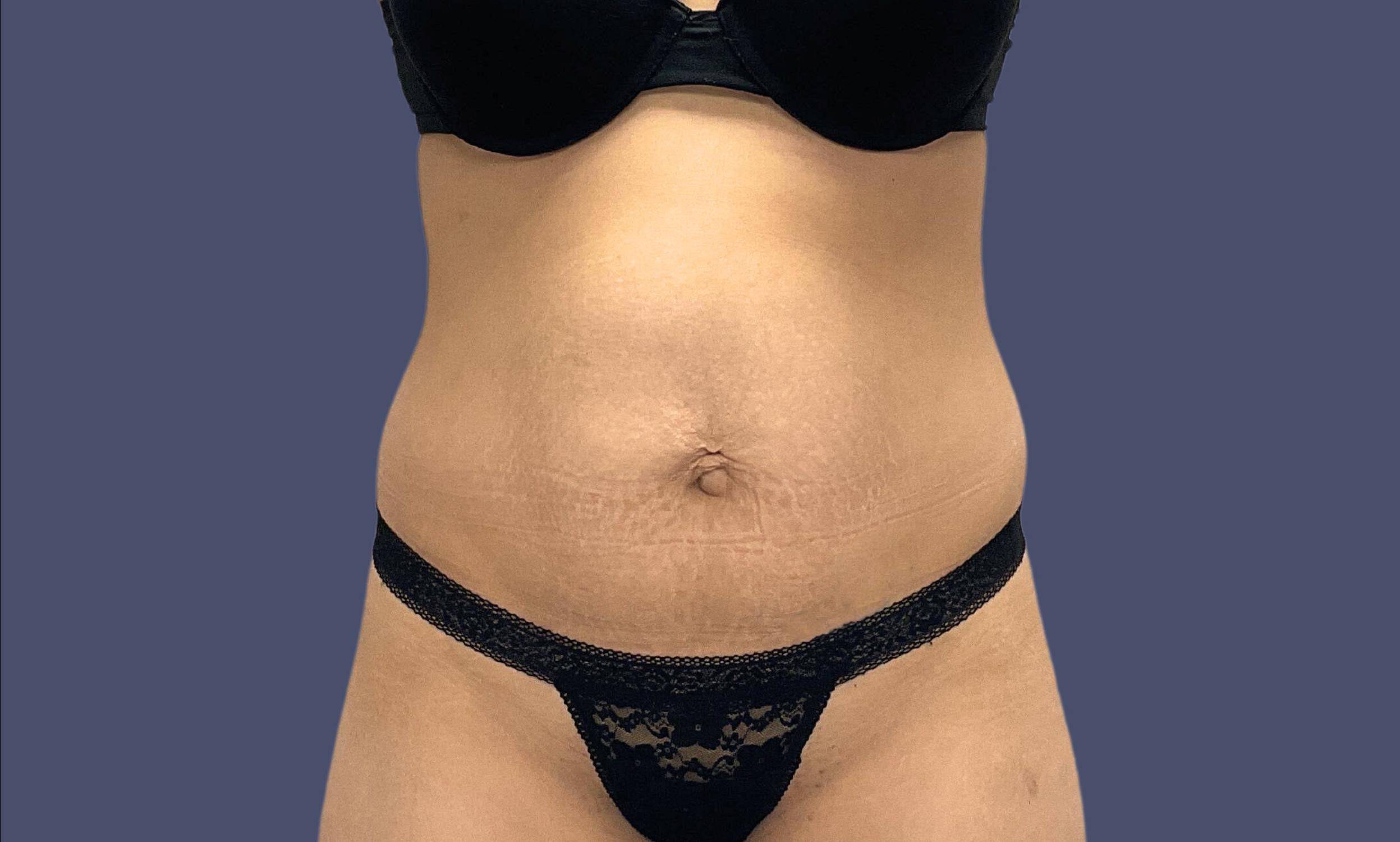 Abdominoplasty (Tummy Tuck) 17 Before