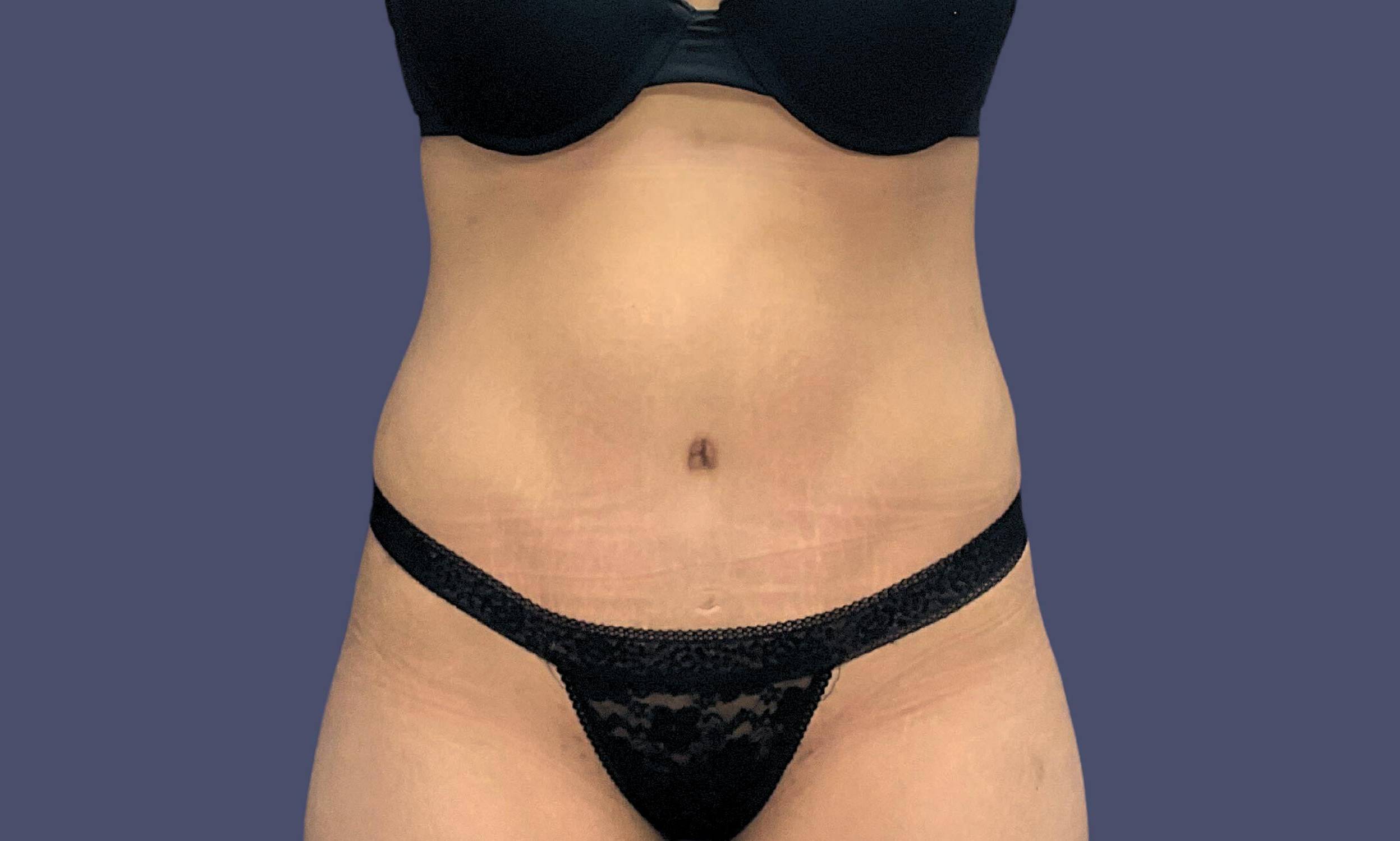 Abdominoplasty (Tummy Tuck) 17 After