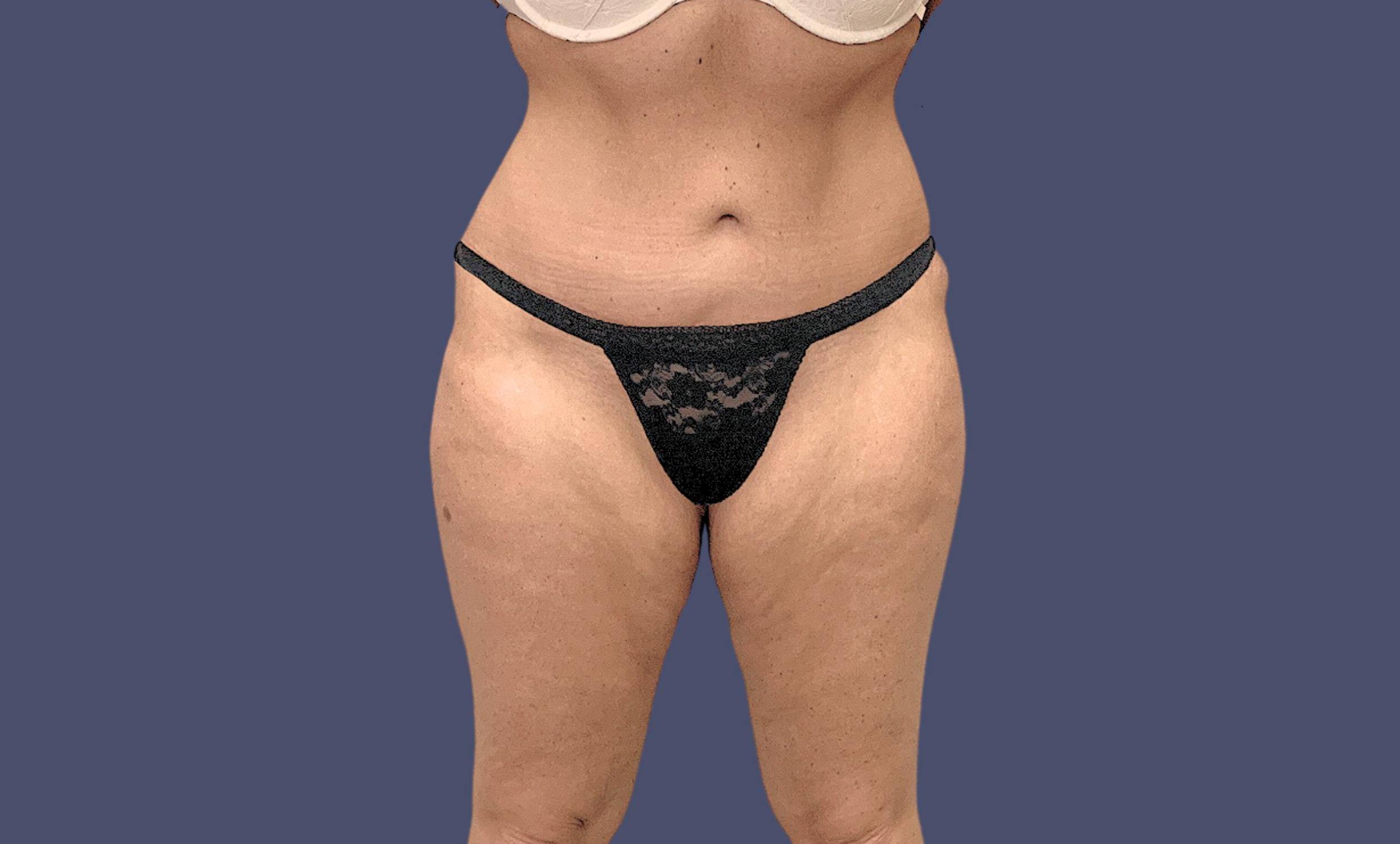 Thigh Lift 3 Before