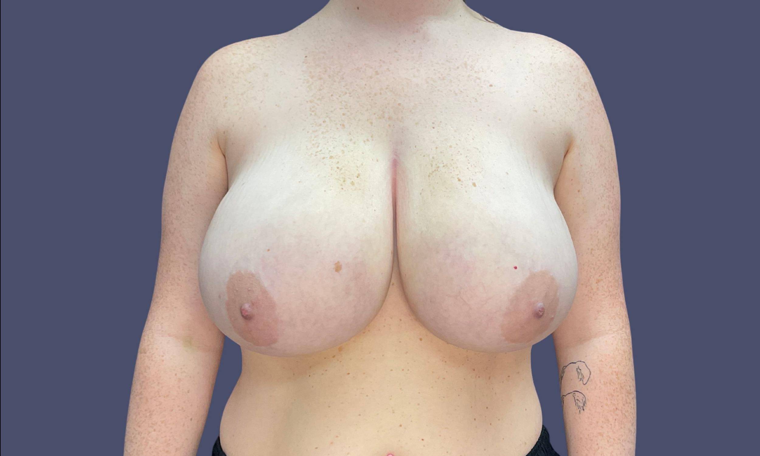Breast Reduction 5 Before