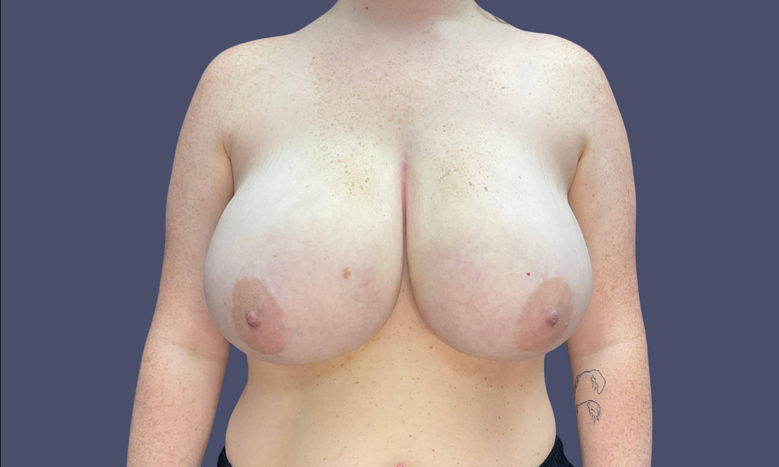 Breast Reduction 5 Before