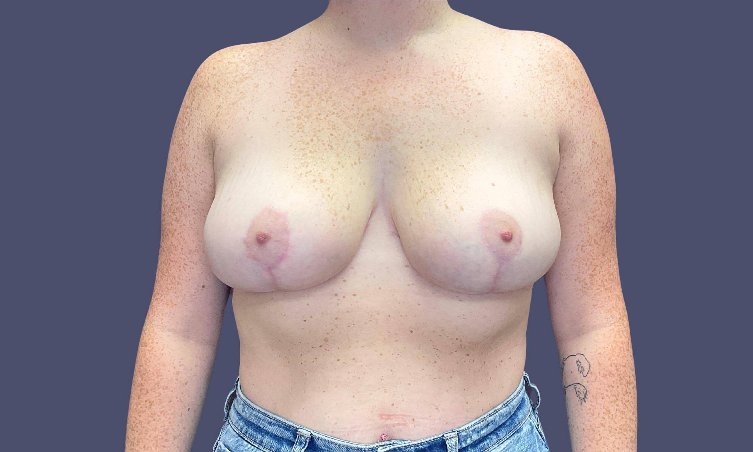 Breast Reduction 5 After