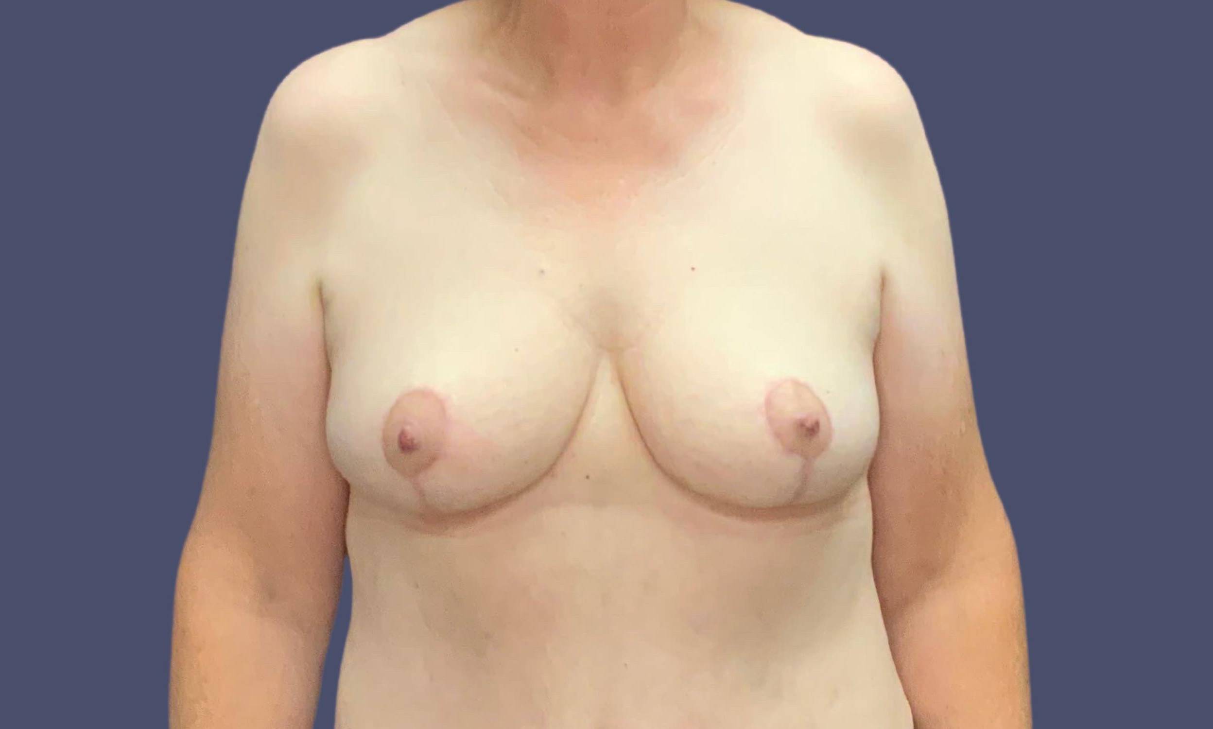 Breast Reduction 11 After