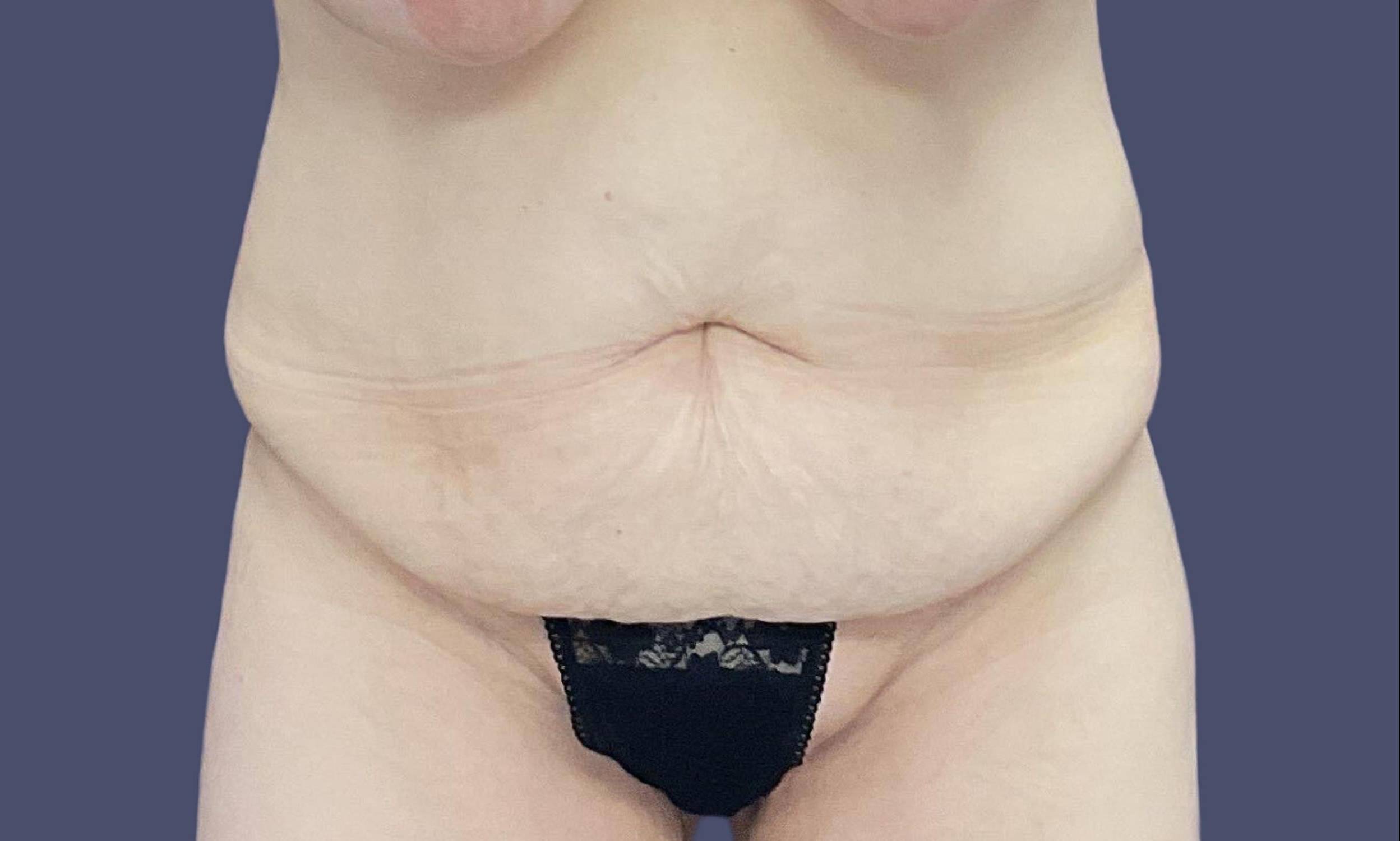 Abdominoplasty (Tummy Tuck) 38 Before