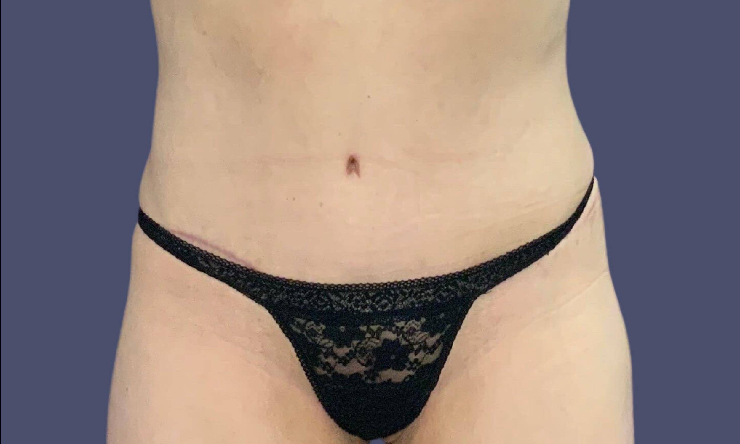 Abdominoplasty (Tummy Tuck) 36 After