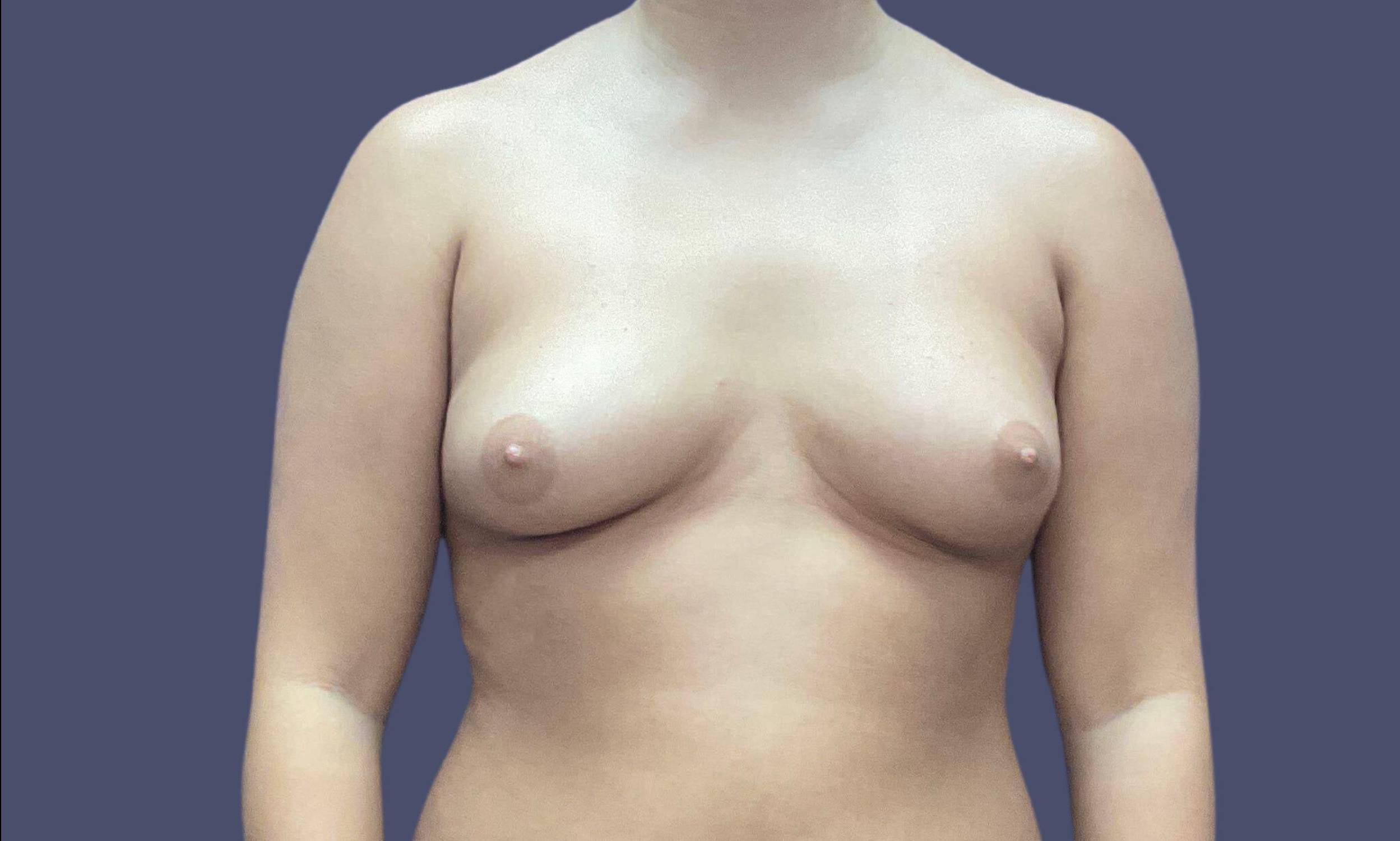 Breast Lift w/ Augmentation 6 Before