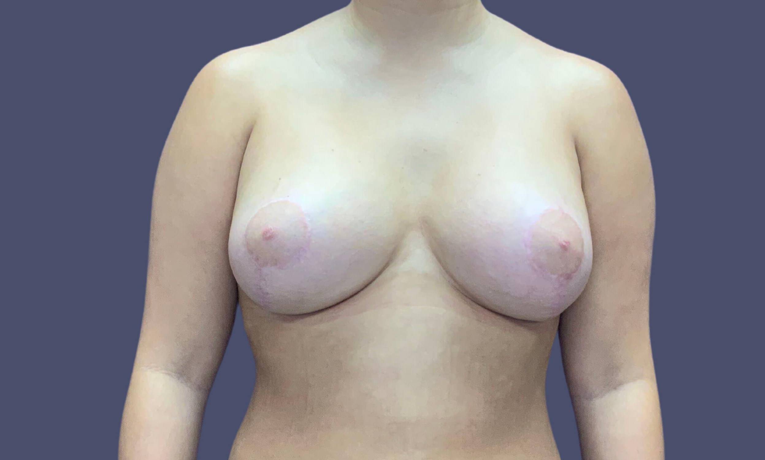 Breast Lift w/ Augmentation 7 After