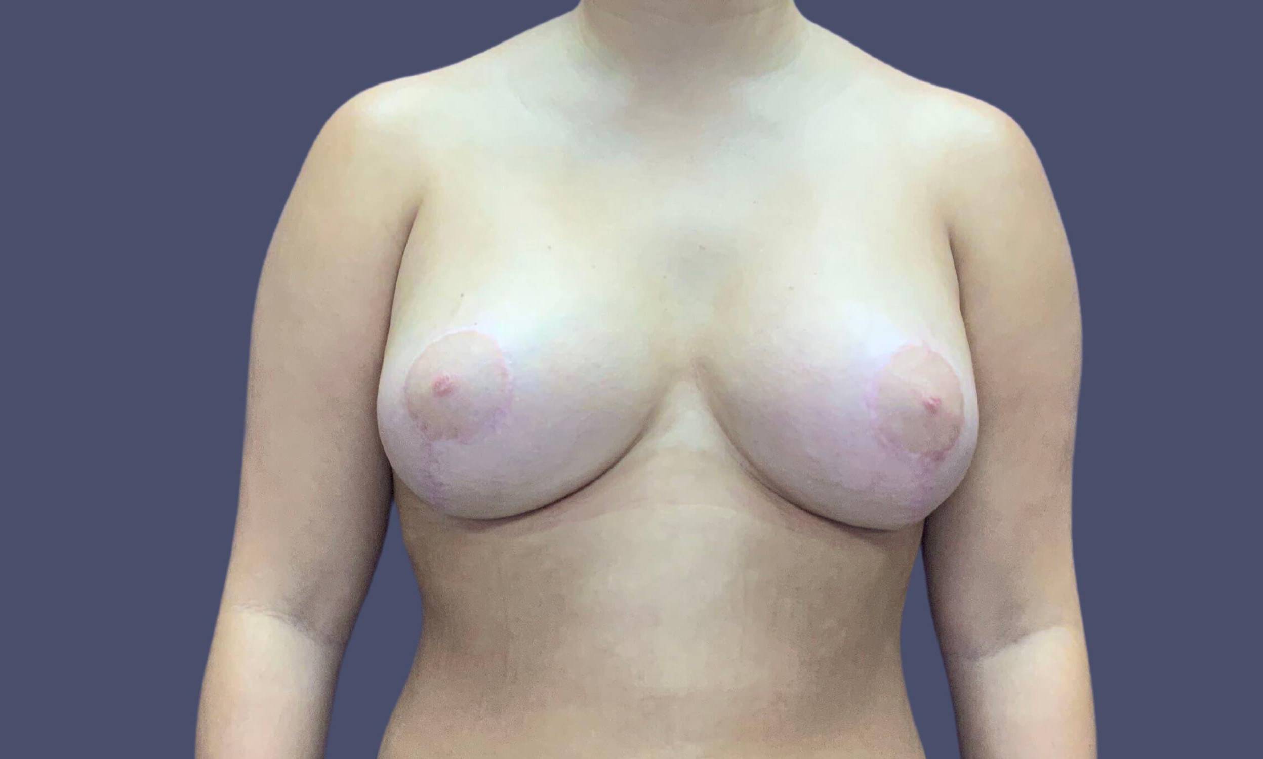 Breast Lift w/ Augmentation 6 After