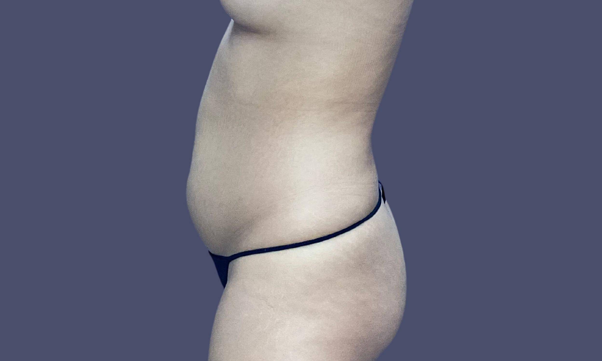 Liposuction 4 - Axilla, Abdomen, and Flanks Before