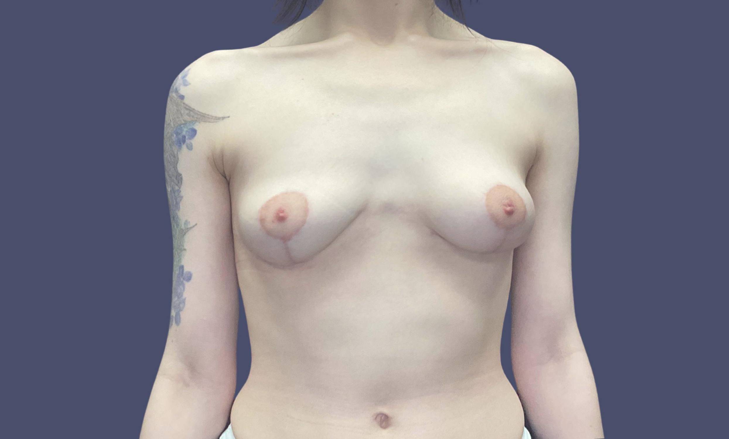 Breast Lift 4 After