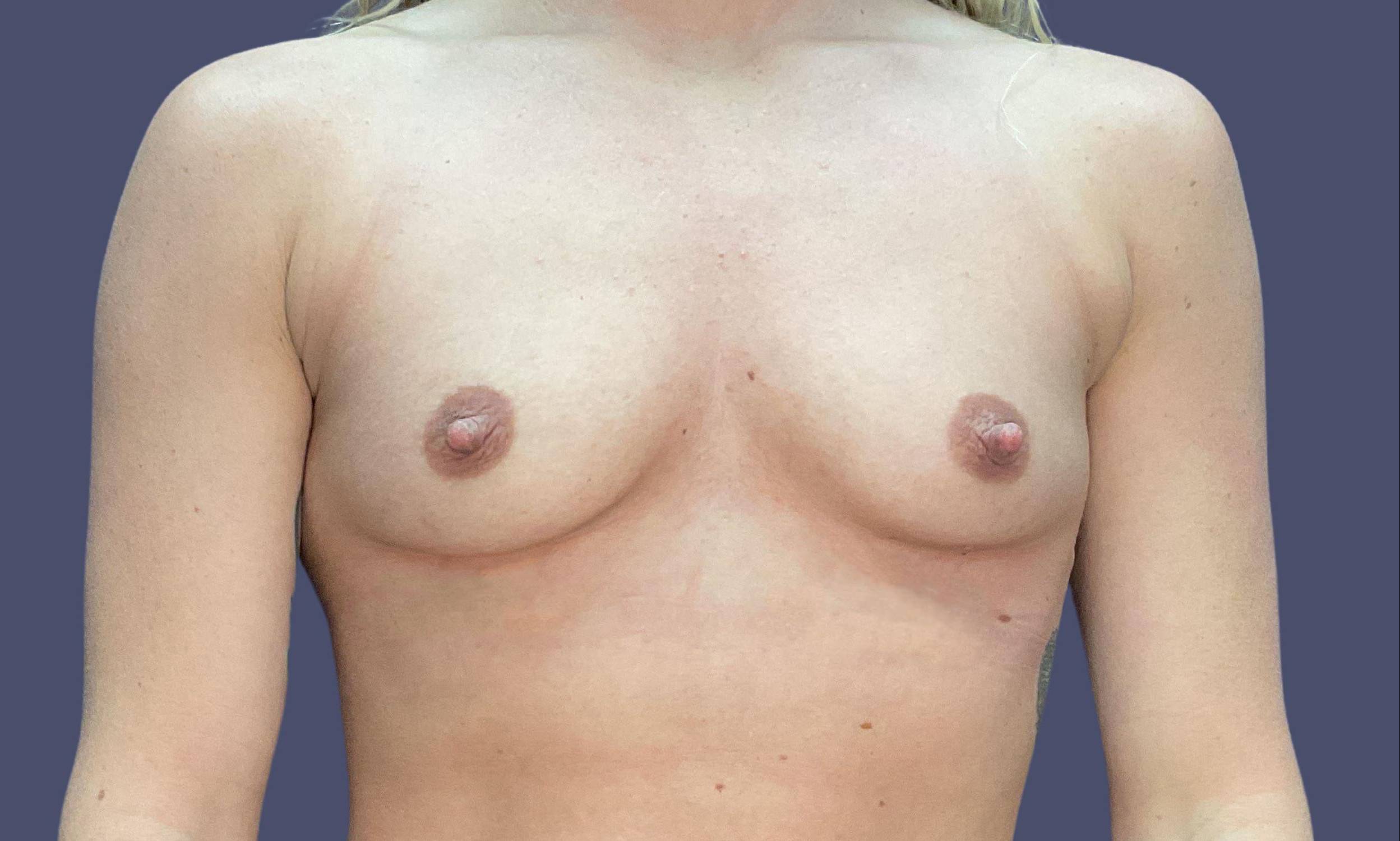 Breast Augmentation 6 Before