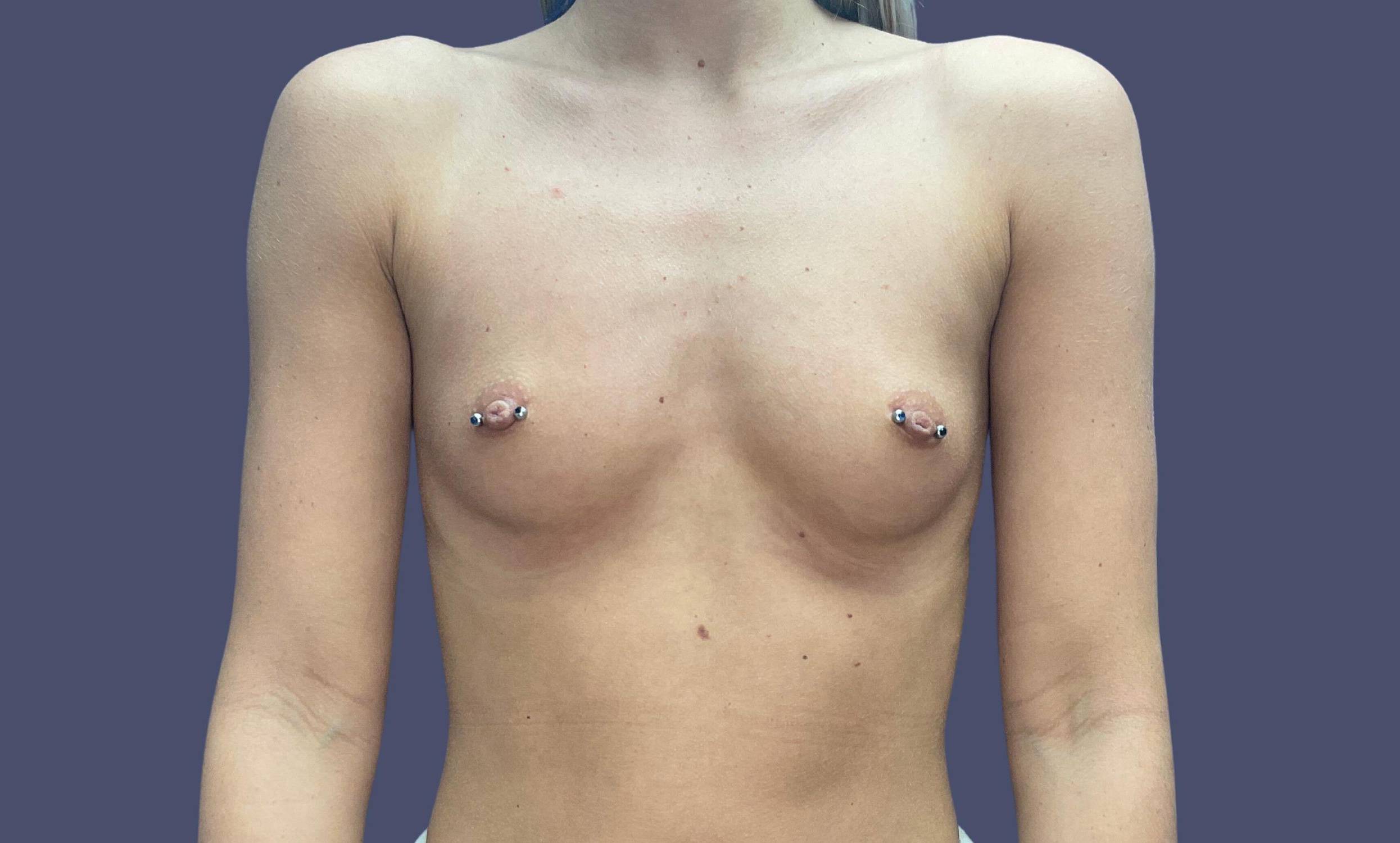 Breast Augmentation 12 Before