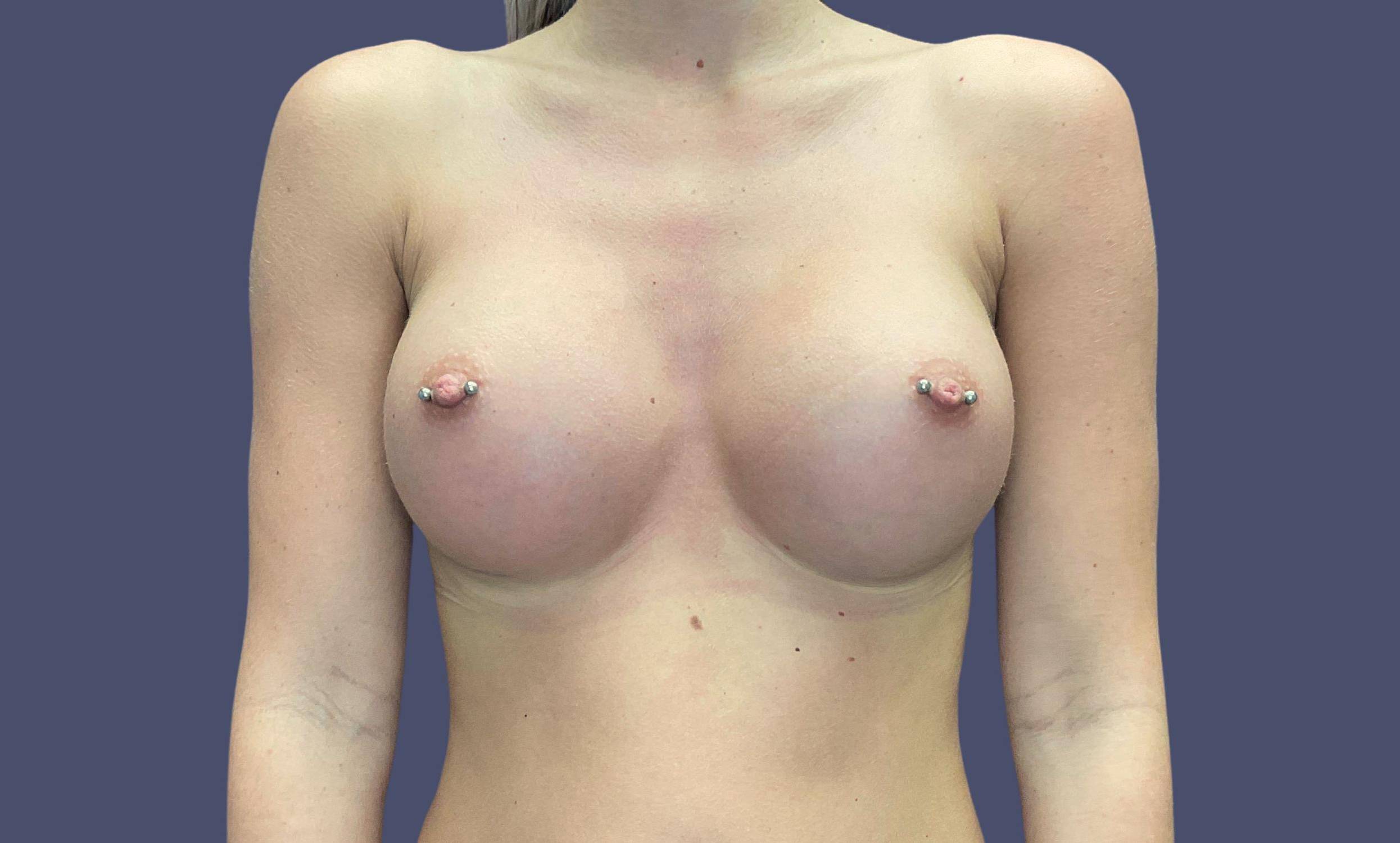 Breast Augmentation 12 After
