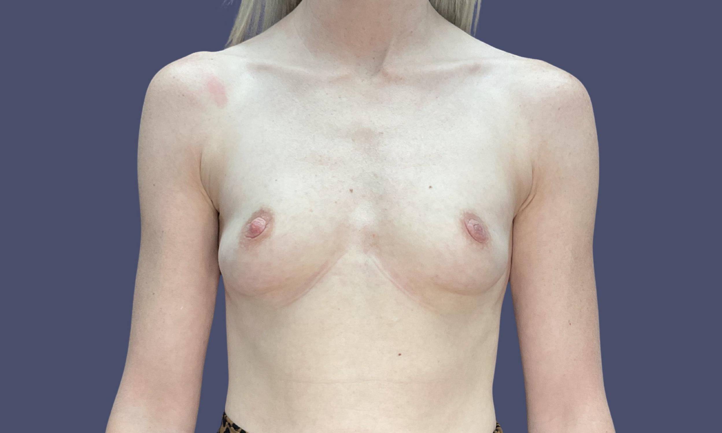 Breast Augmentation 13 Before