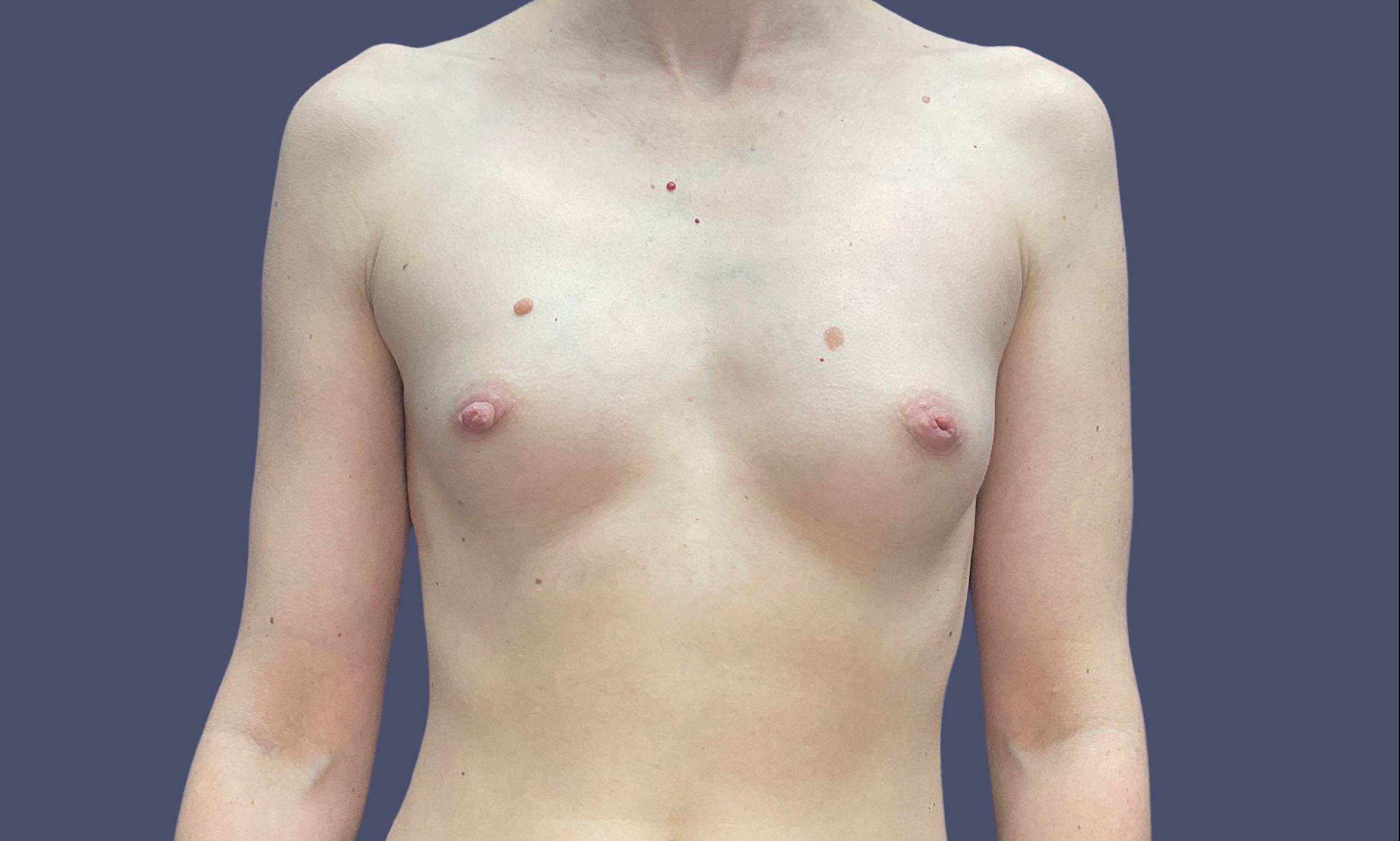 Breast Augmentation 20 Before