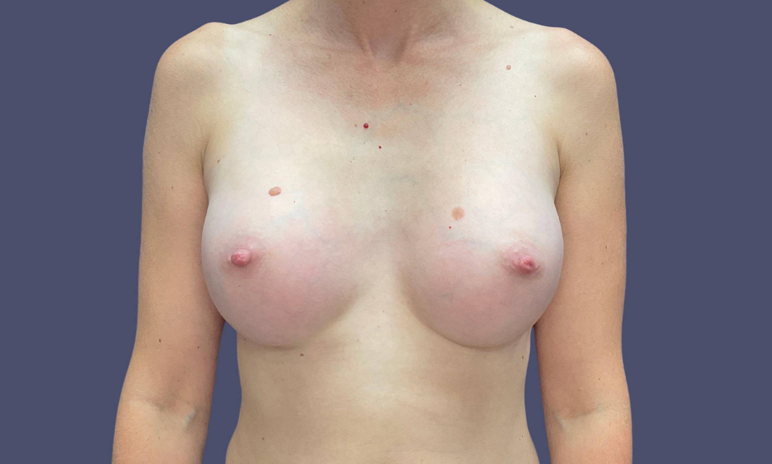 Breast Augmentation 23 After