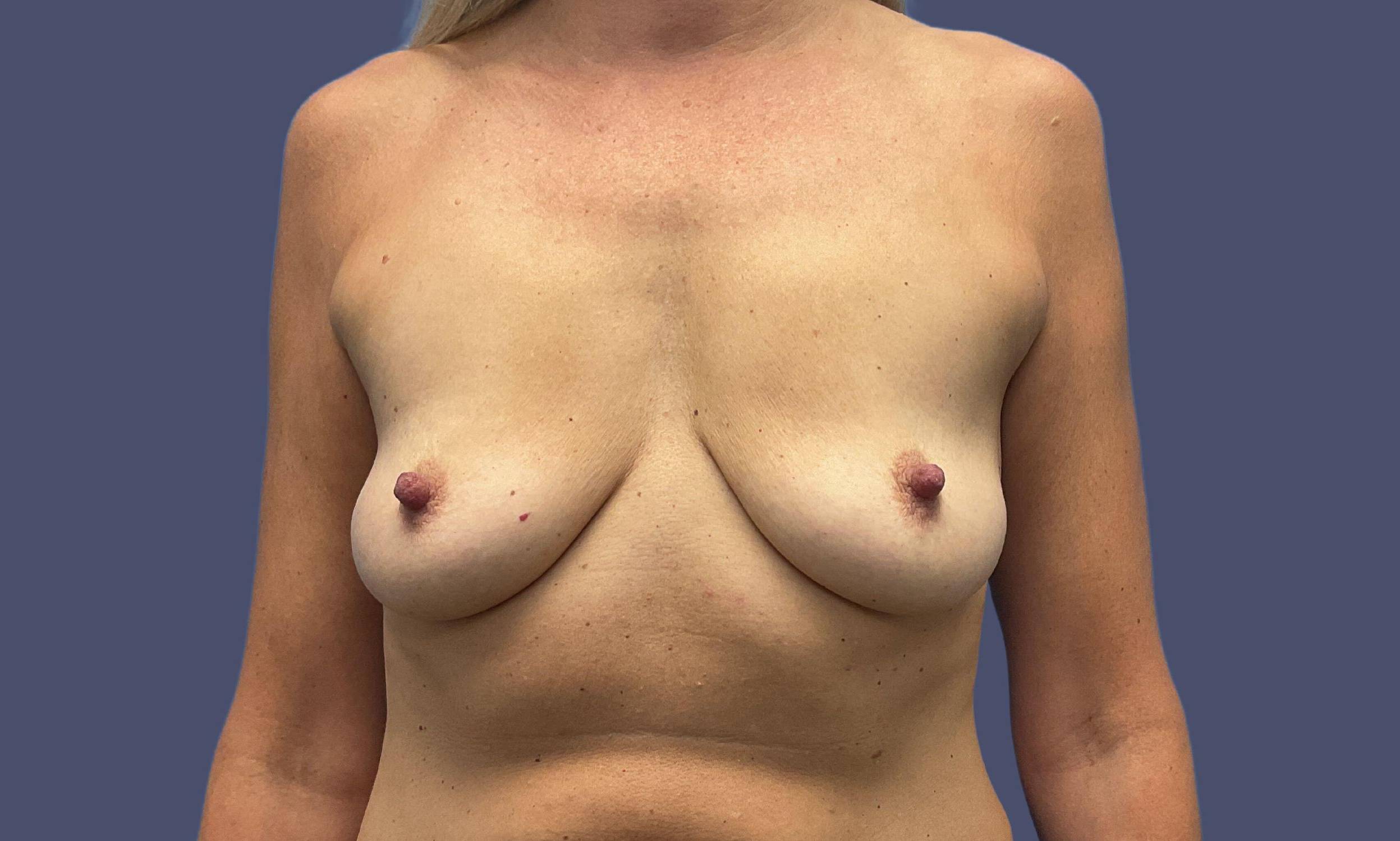 Breast Lift w/Augmentation 12 Before