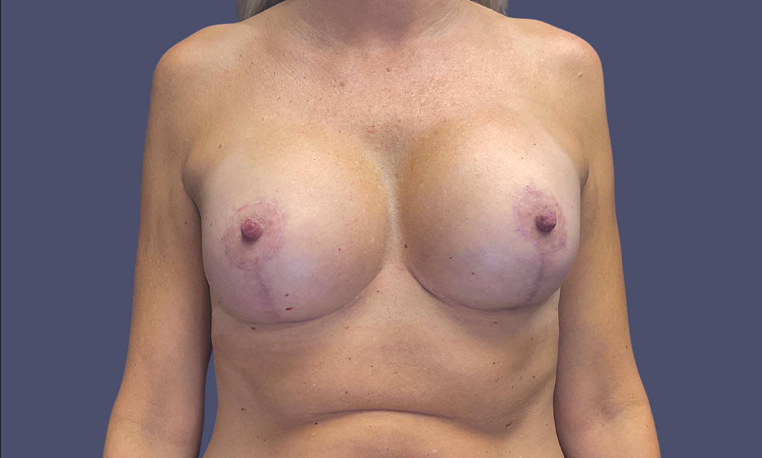 Breast Lift w/Augmentation 15 After
