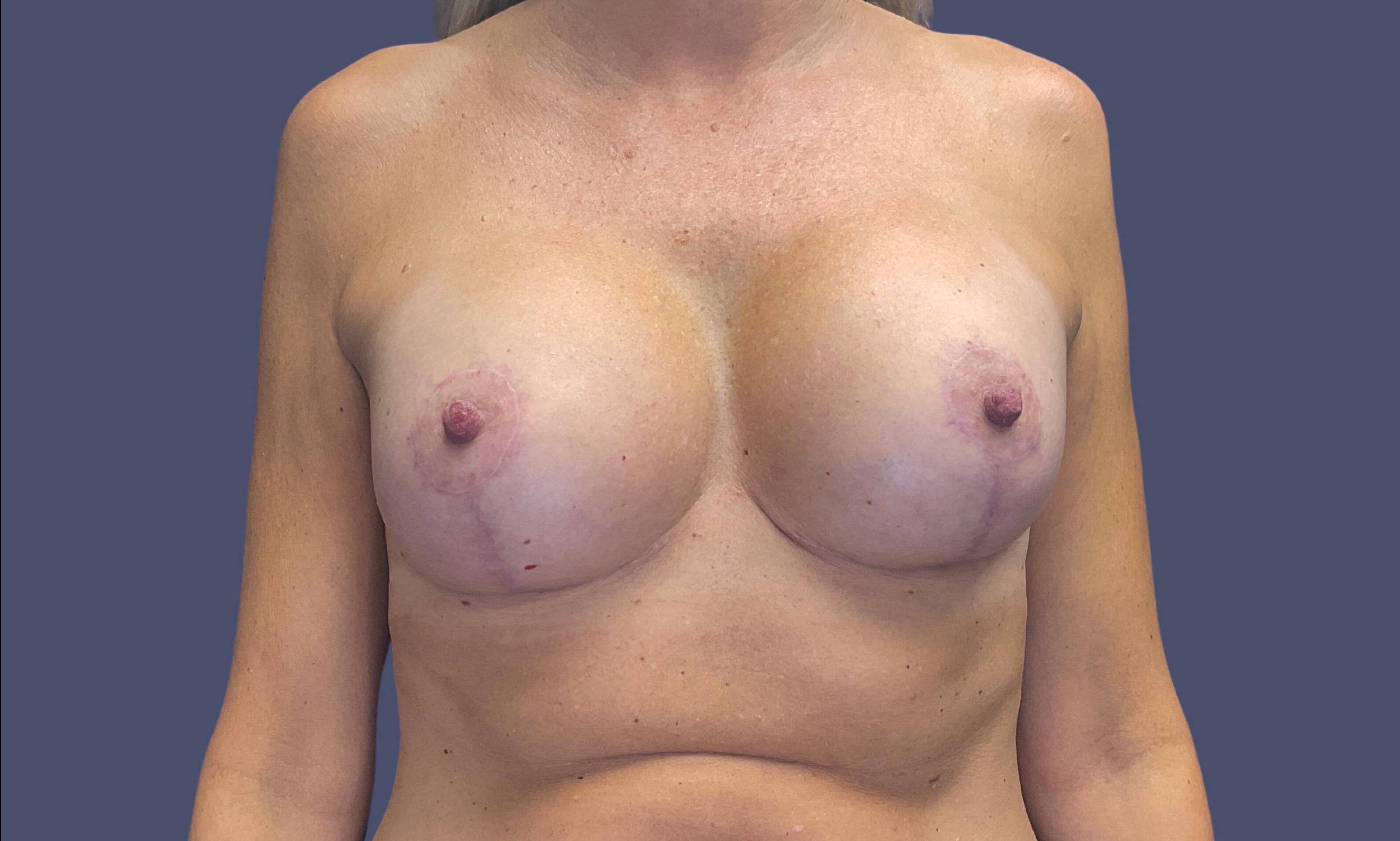 Breast Lift w/Augmentation 12 After