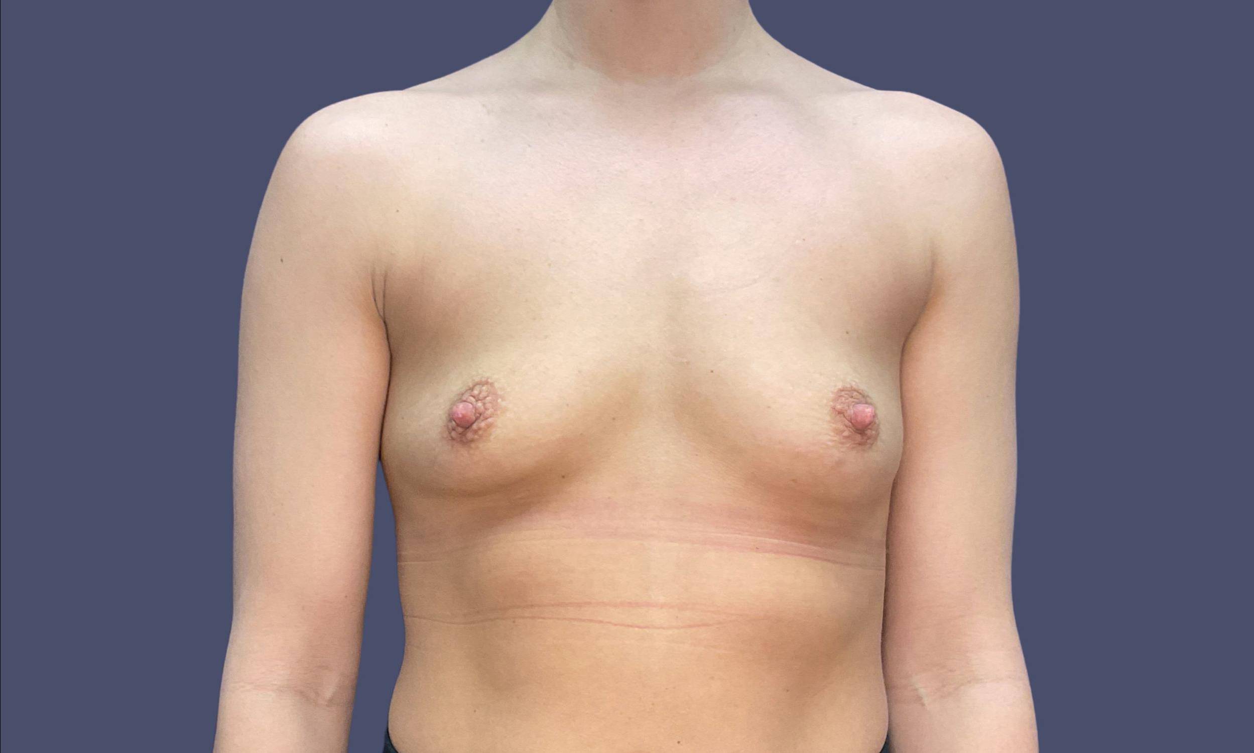 Breast Augmentation 24 Before