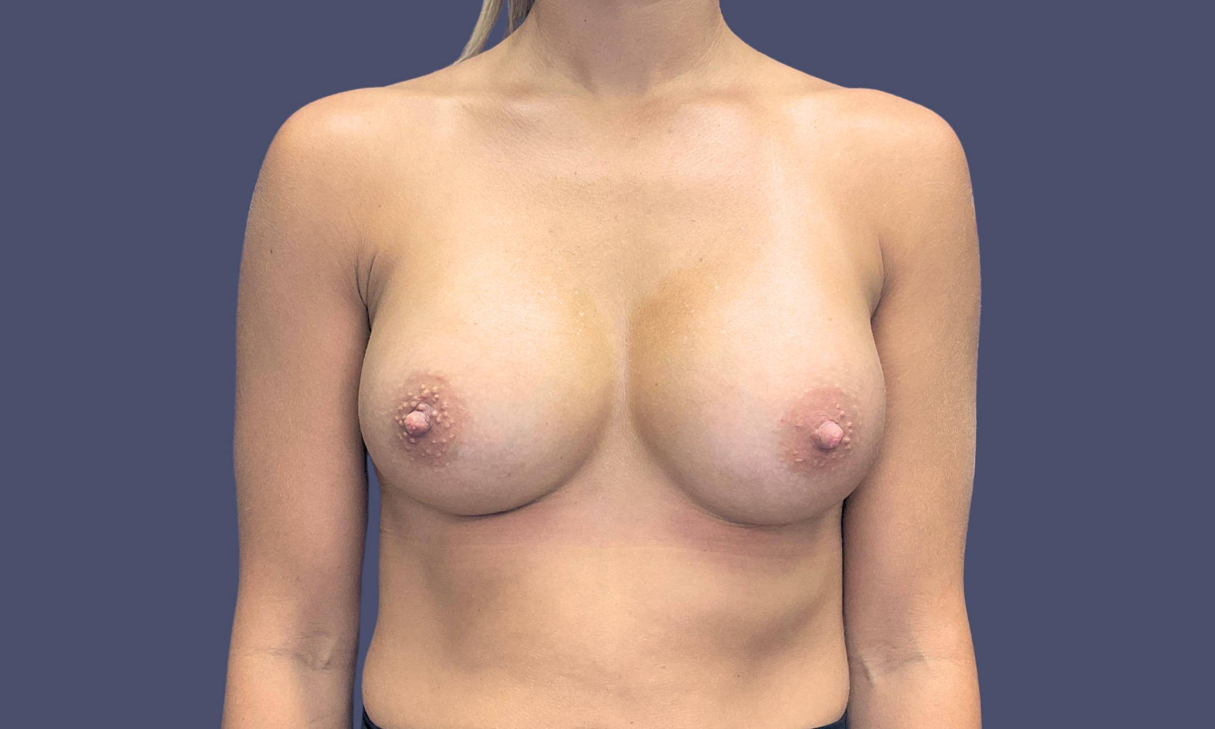 Breast Augmentation 21 After
