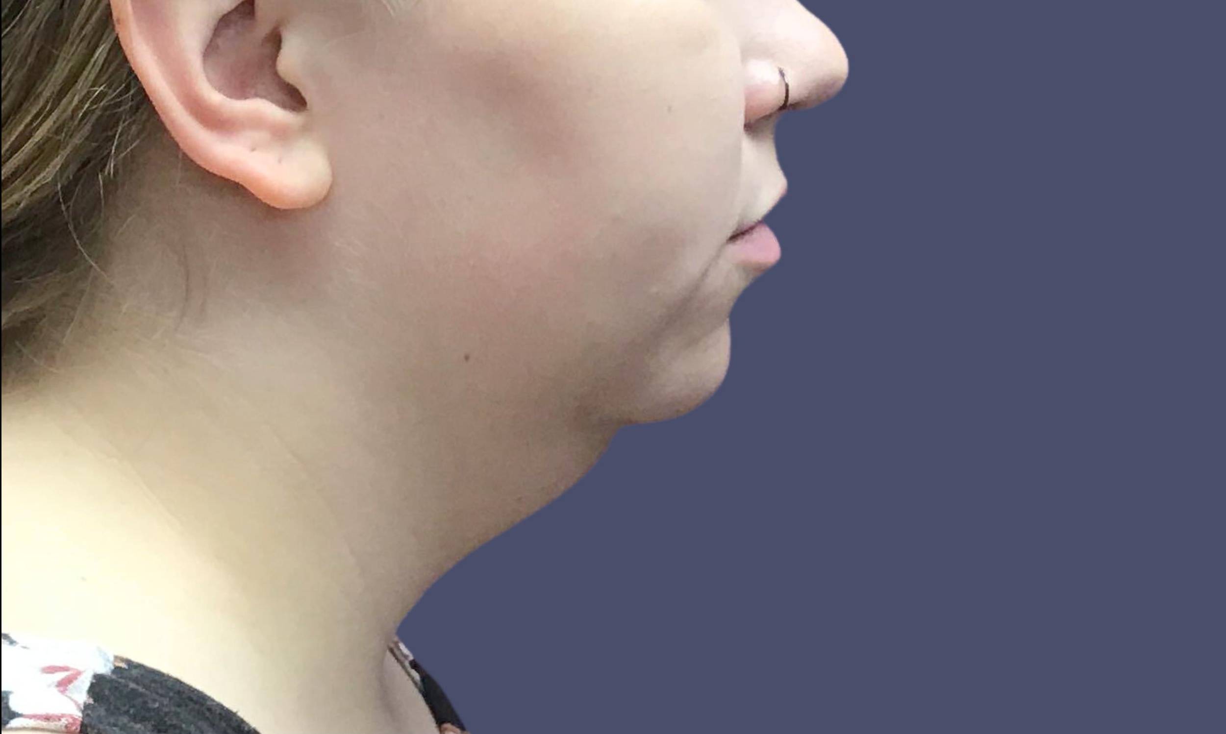 Submental Liposuction 2 Before