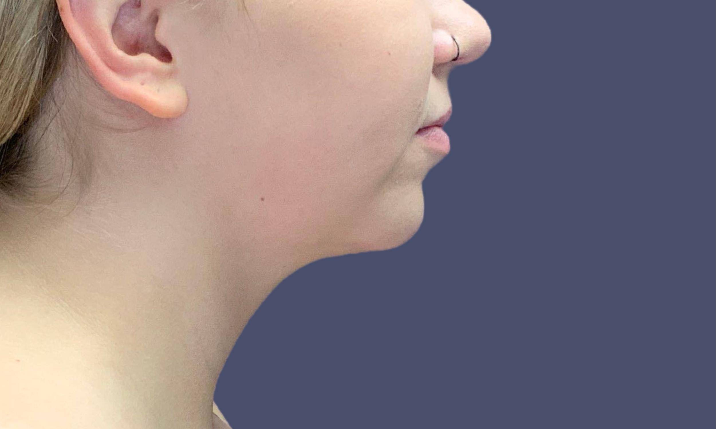 Submental Liposuction 2 After