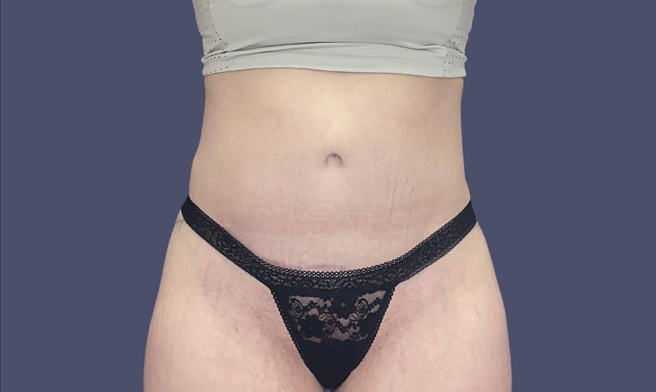 Post Weight Loss 3 After
