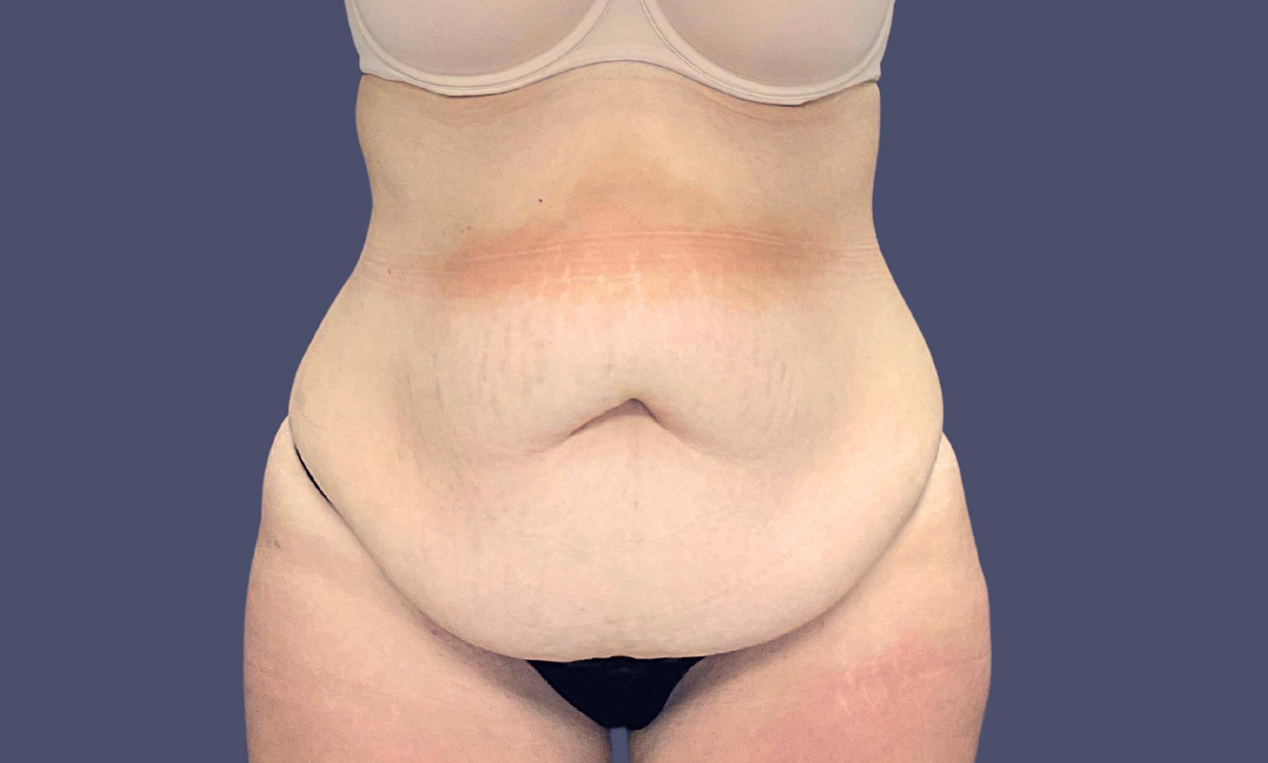 Abdominoplasty (Tummy Tuck) 8 Before
