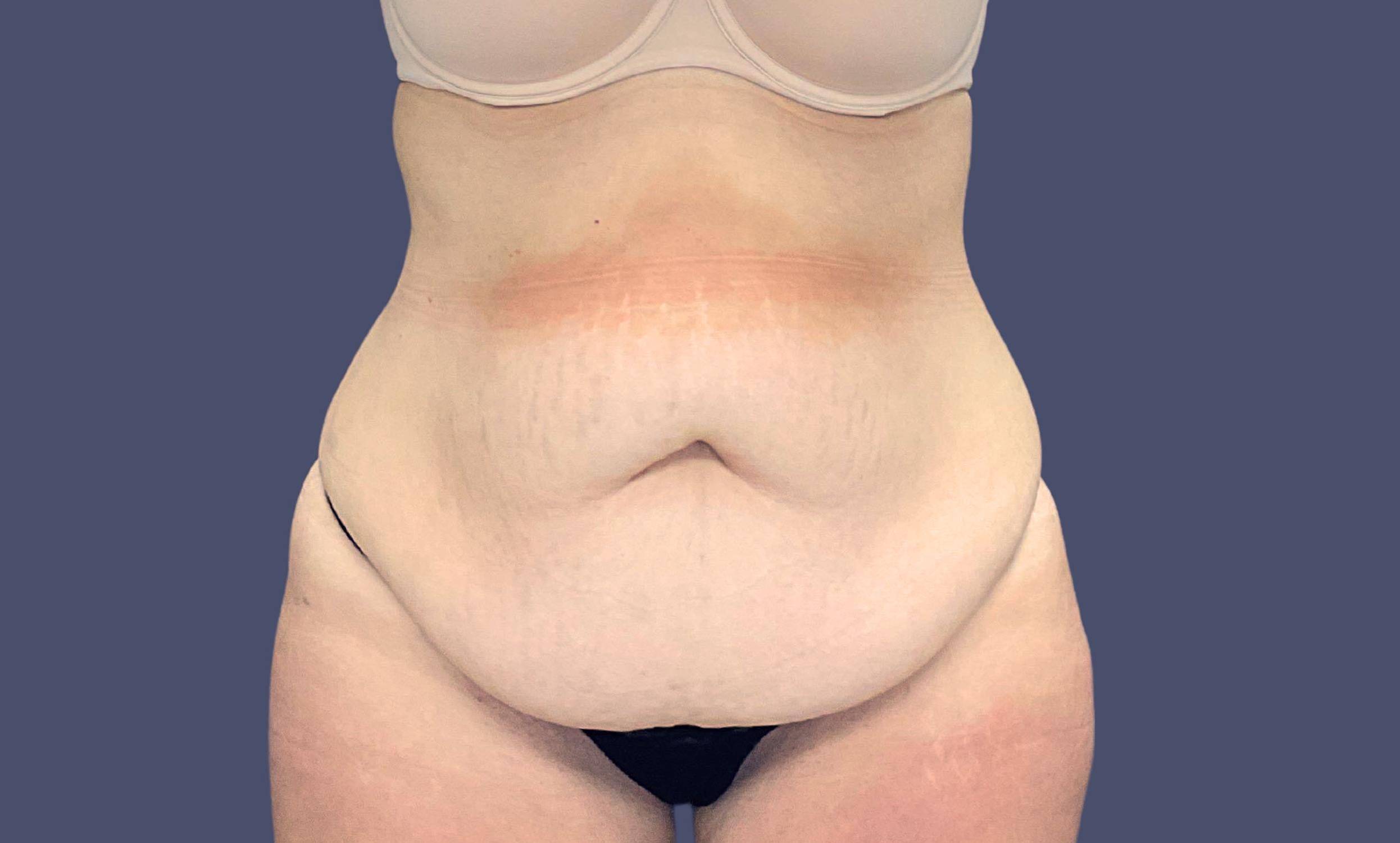 Abdominoplasty (Tummy Tuck) 6 Before