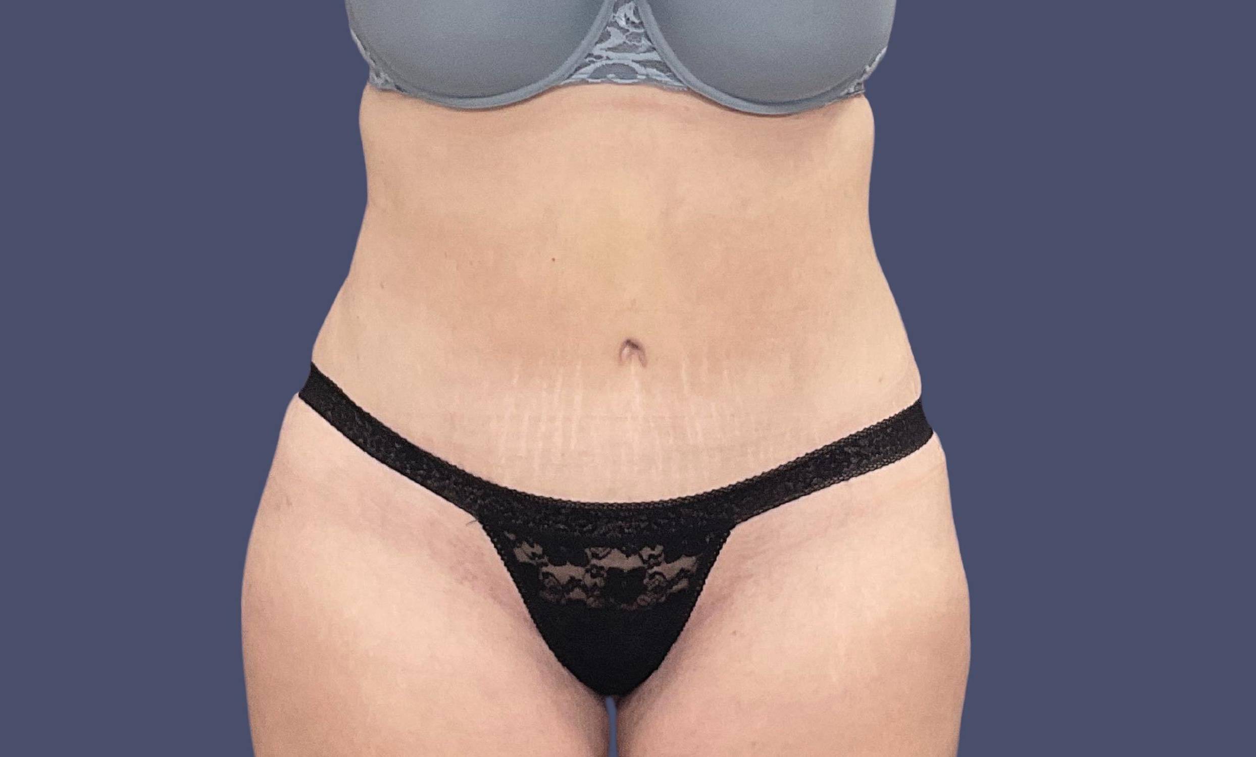 Abdominoplasty (Tummy Tuck) 8 After