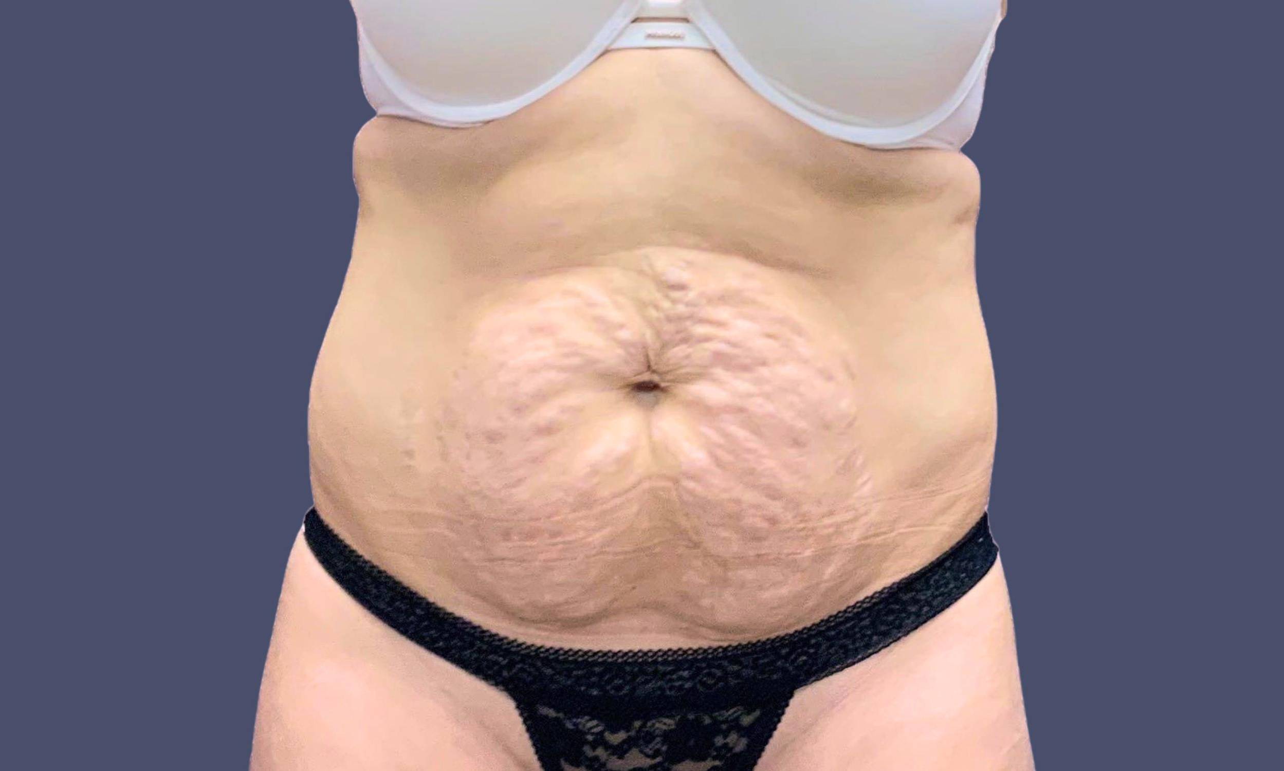 Abdominoplasty (Tummy Tuck) 26 Before