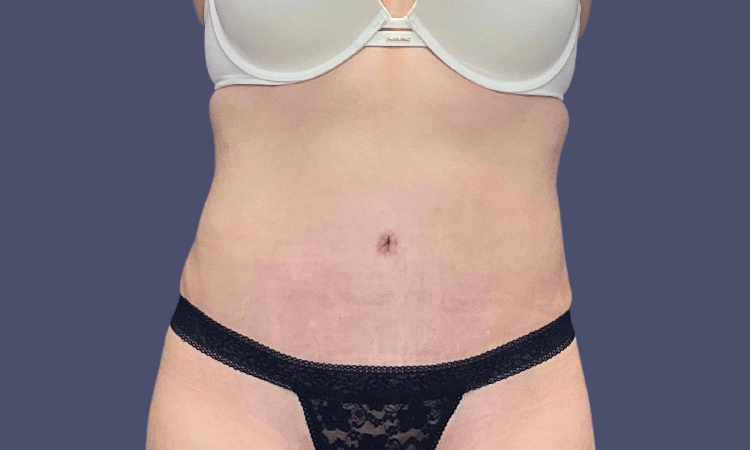 Abdominoplasty (Tummy Tuck) 23 After