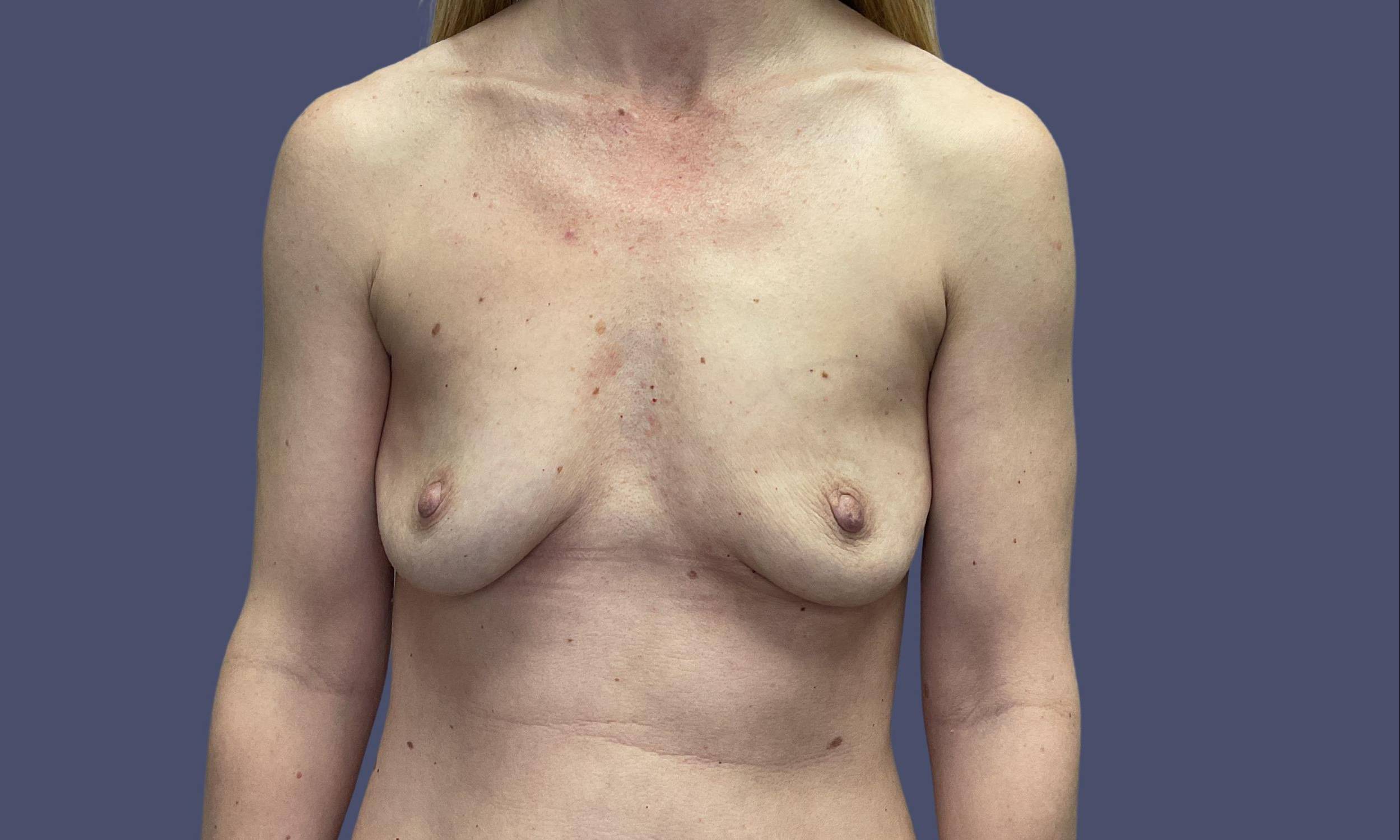 Breast Lift w/Fat Transfer 3 Before