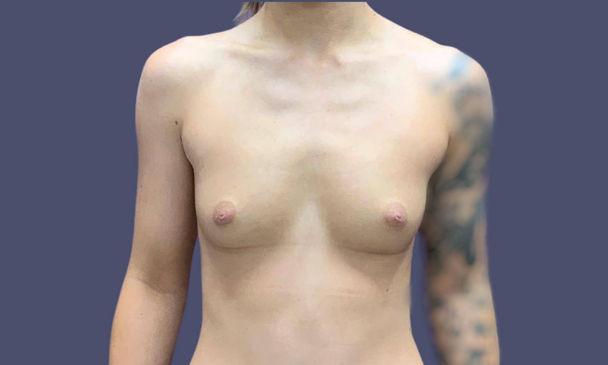 Breast Augmentation 22 Before