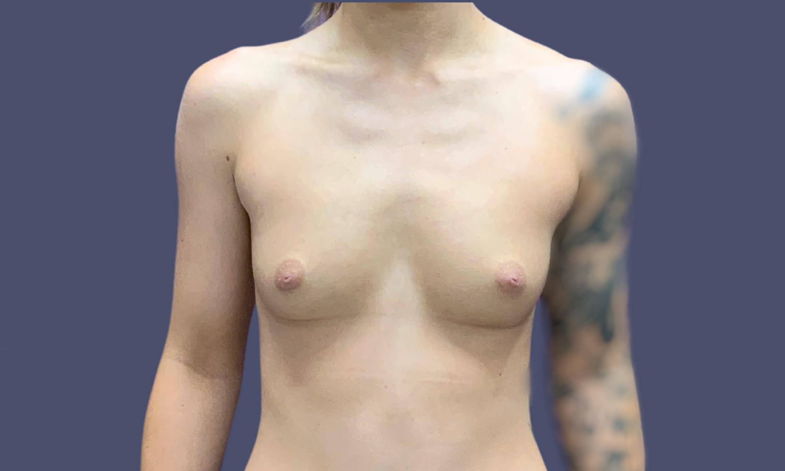 Breast Augmentation 25 Before