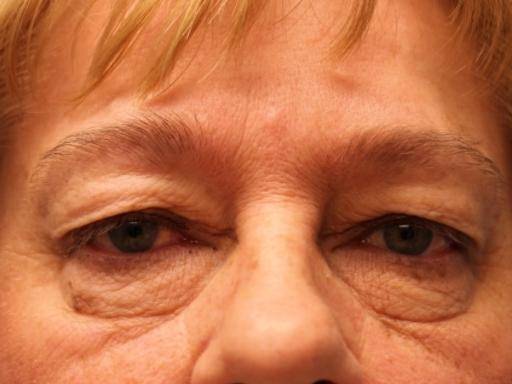 Blepharoplasty 4 - Upper Before