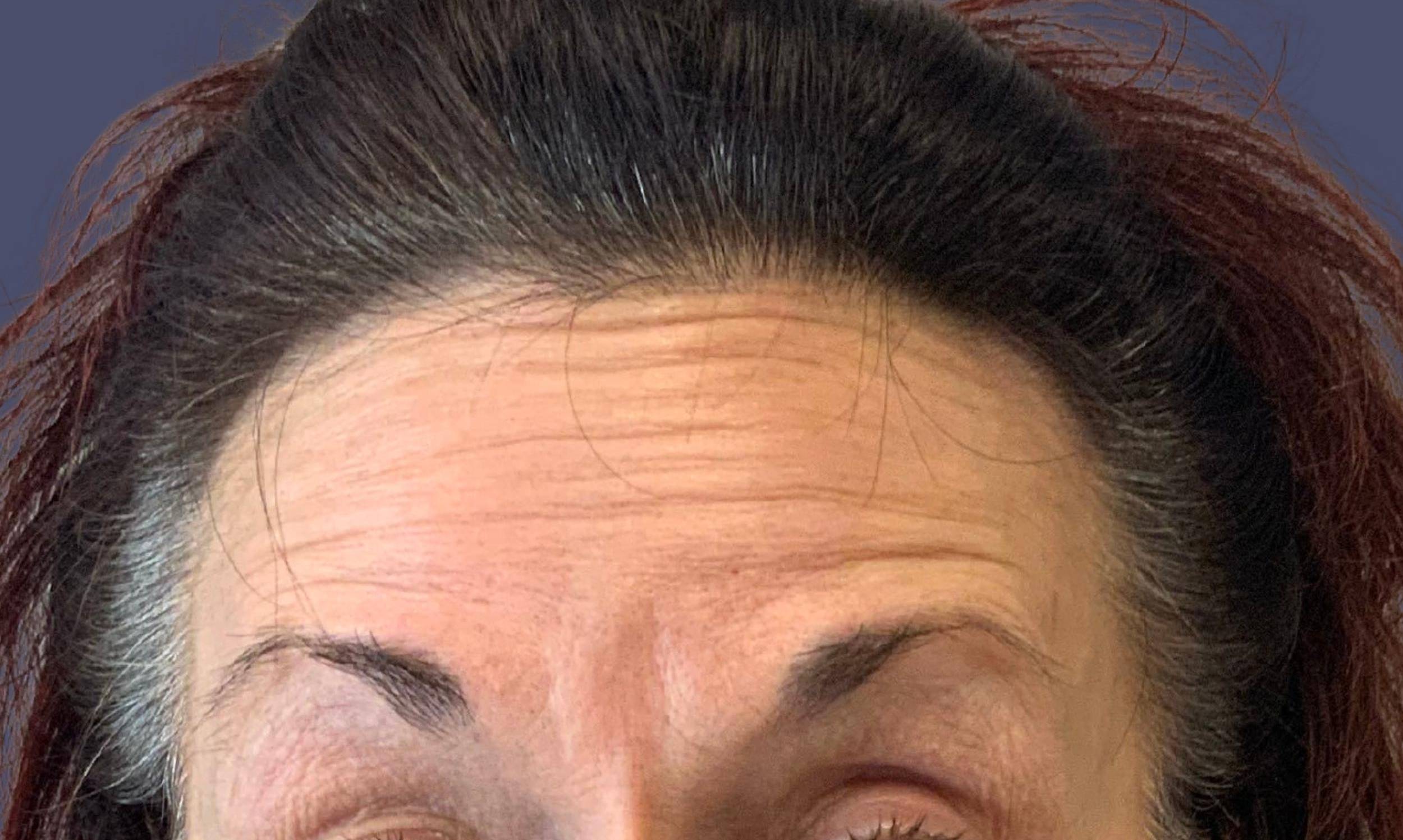 Tox 5 - Dysport Before