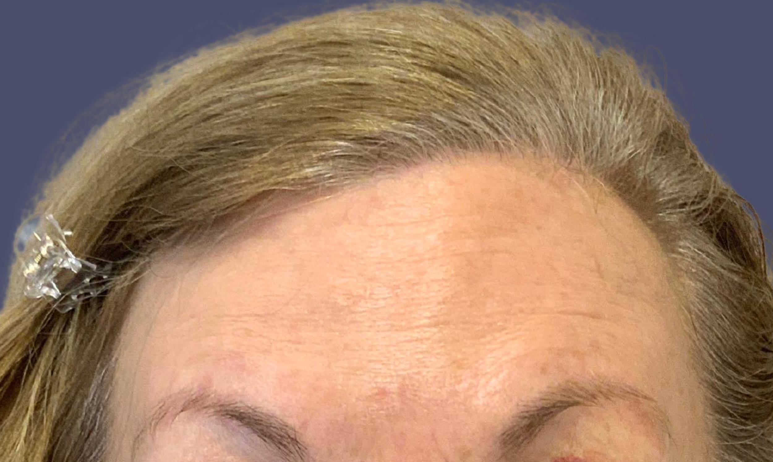 Tox 7 - Botox After