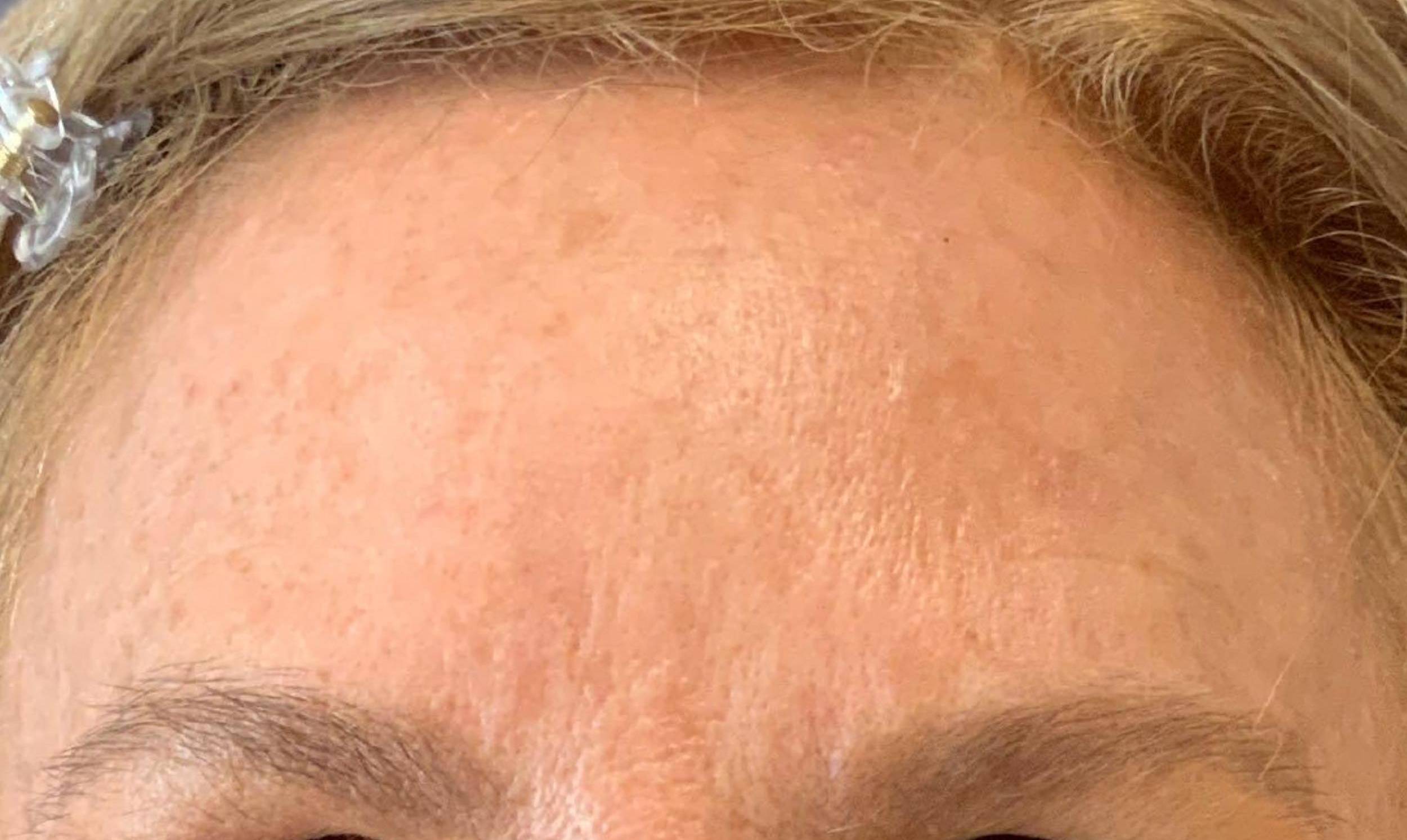 Tox 6 - Botox After
