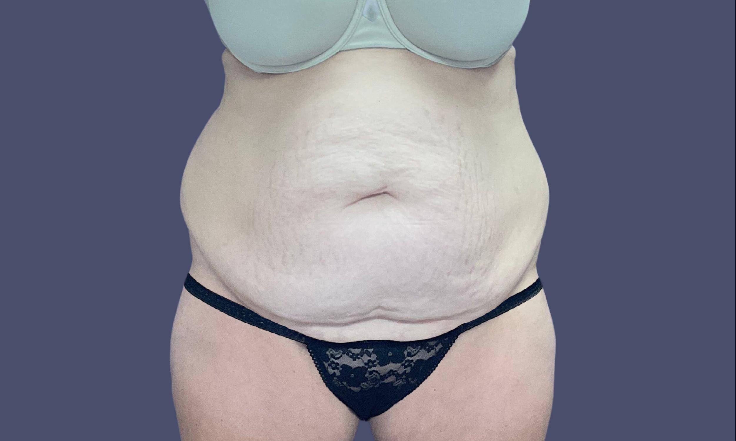 Abdominoplasty (Tummy Tuck) 27 Before