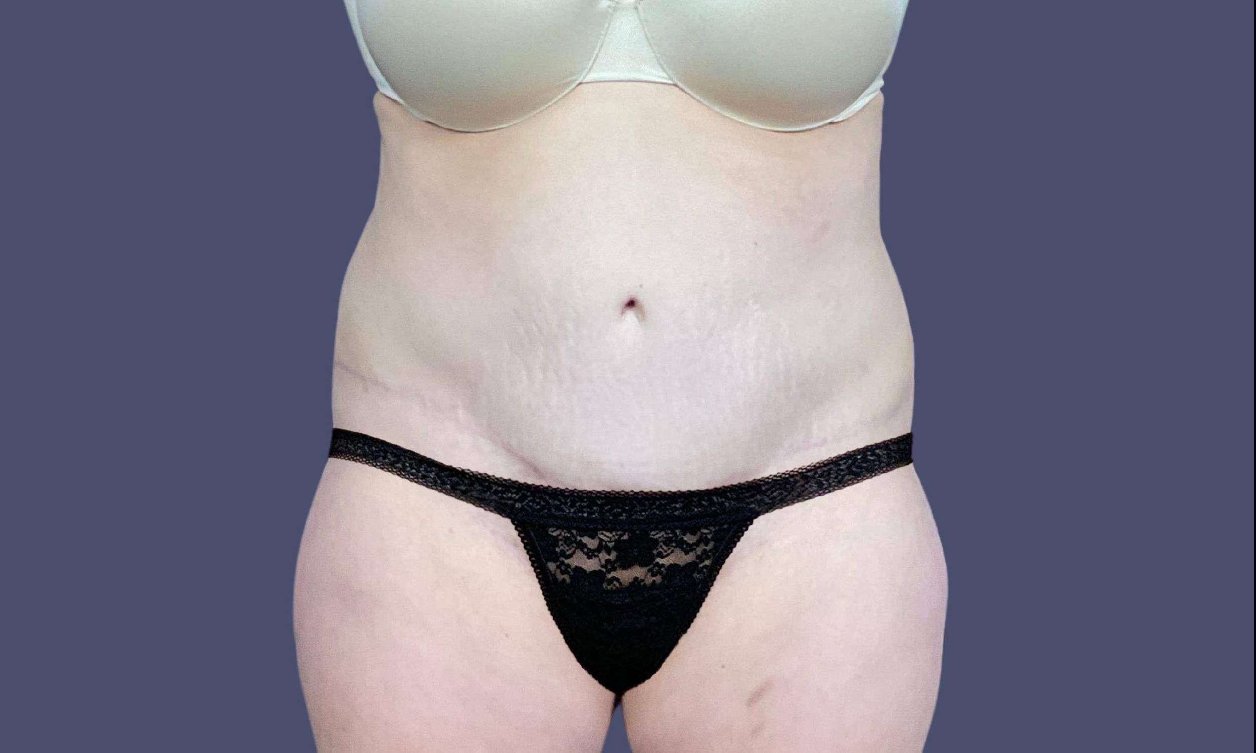 Abdominoplasty (Tummy Tuck) 27 After