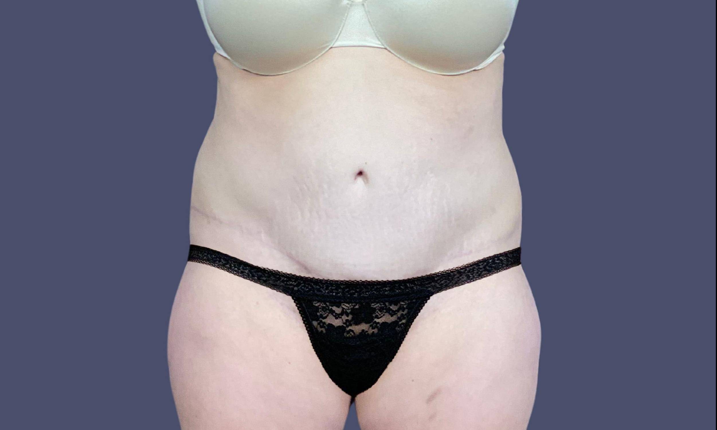 Abdominoplasty (Tummy Tuck) 24 After