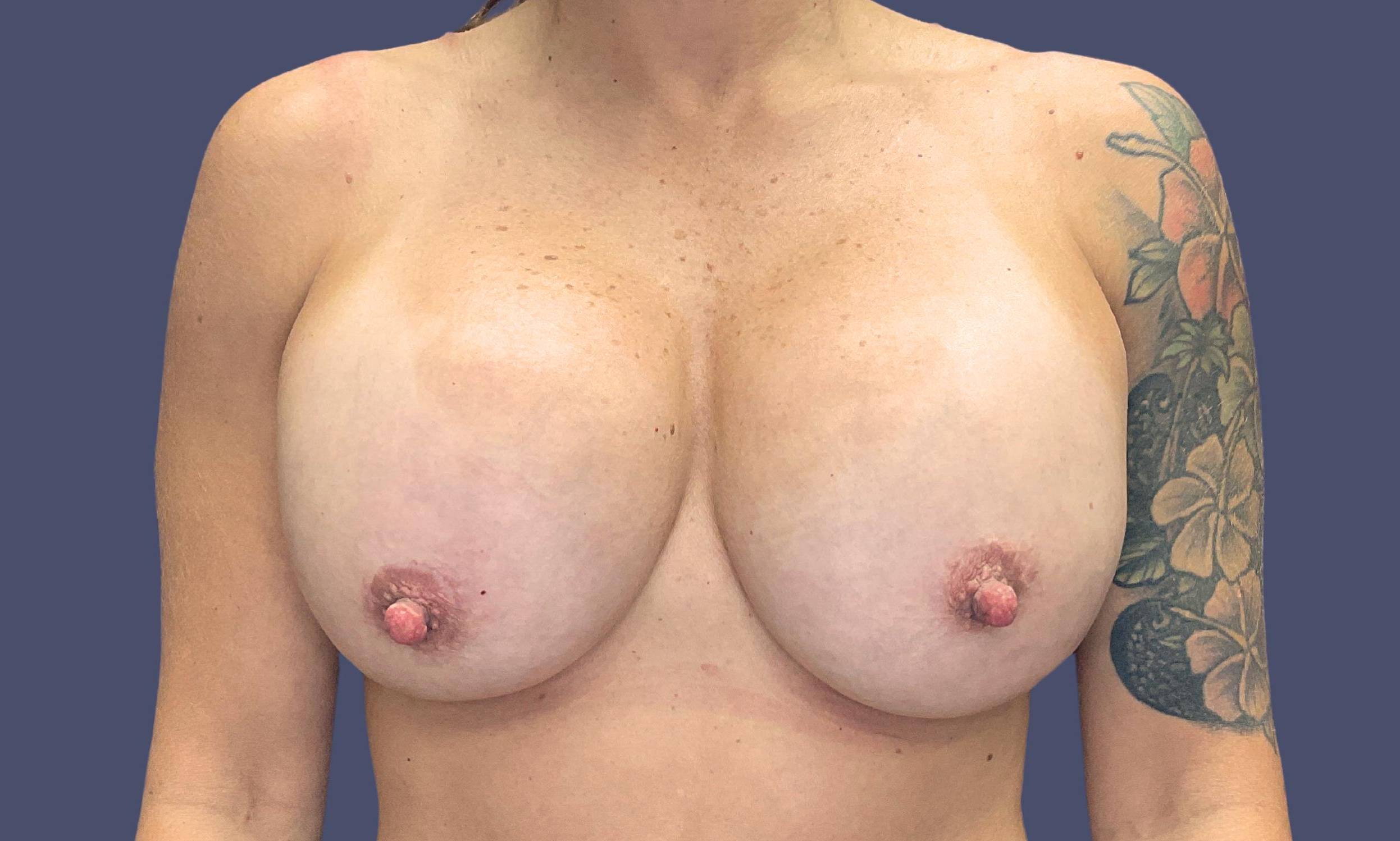 Breast Revision 2 Before