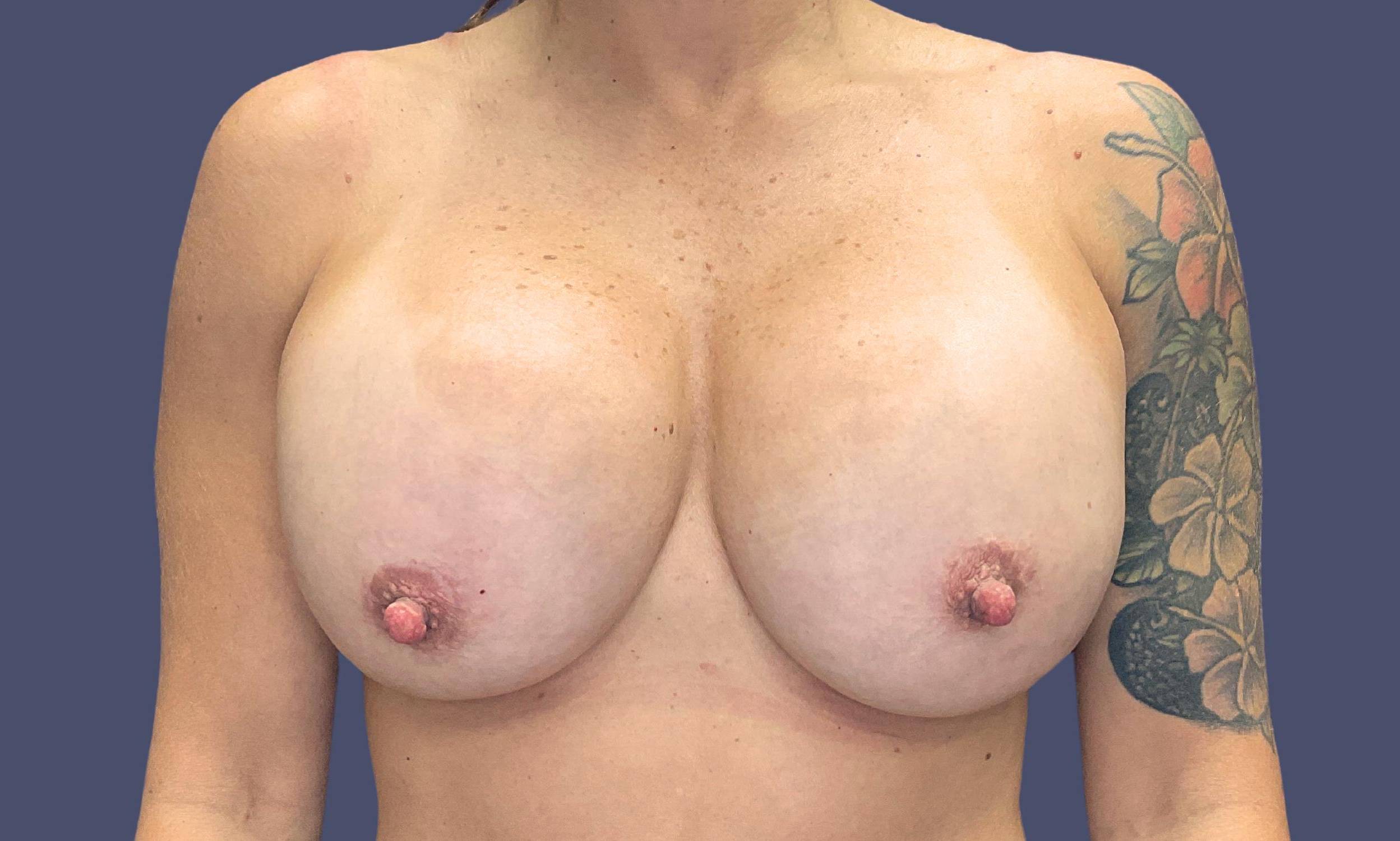 Breast Lift w/ Augmentation 19 Before